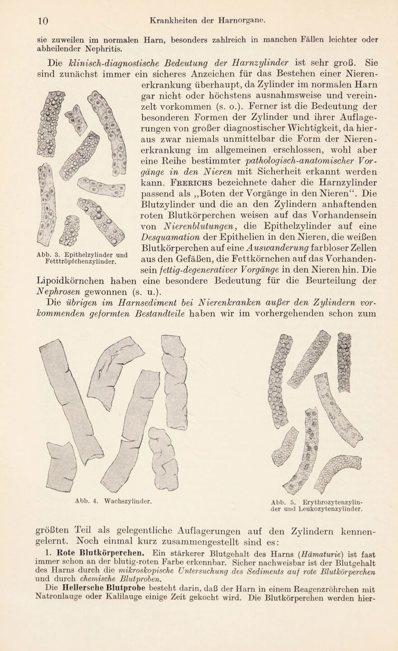 sie zuweilen im normalen Harn, besonders zahlreich in manchen Fällen leichter oder abheilender Nephritis. Die klinisch-diagnostische Bedeutung der Harnzylinder ist sehr groß. Sie sind zunächst immer ein sicheres Anzeichen für das Bestehen einer Nieren¬ erkrankung überhaupt, da Zylinder im normalen Harn gar nicht oder höchstens ausnahmsweise und verein¬ zelt Vorkommen (s. o.). Ferner ist die Bedeutung der besonderen Formen der Zylinder und ihrer Auflage¬ rungen von großer diagnostischer Wichtigkeit, da hier¬ aus zwar niemals unmittelbar die Form der Nieren - erkrankung im allgemeinen erschlossen, wohl aber eine Reihe bestimmter pathologisch-anatomischer Vor¬ gänge in den Nieren mit Sicherheit erkannt werden kann. Frerichs bezeichnete daher die Harnzylinder passend als ,,Boten der Vorgänge in den Nieren“. Die Blutzylinder und die an den Zylindern anhaftenden roten Blutkörperchen weisen auf das Vorhandensein von Nierenblutungen, die Epithelzylinder auf eine Desquamation der Epithelien in den Nieren, die weißen Blutkörperchen auf eine Auswanderung farbloser Zellen aus den Gefäßen, die Fettkörnchen auf das Vorhanden¬ sein fettig-degenerativer Vorgänge in den Nieren hin. Die Lipoidkörnchen haben eine besondere Bedeutung für die Beurteilung der Nephrosen gewonnen (s. u.). Die übrigen im Harnsediment bei Nierenkranken außer den Zylindern vor- kommenden geformten Bestandteile haben wir im vorhergehenden schon zum Abb. 3. Epithelzylinder und Fetttröpfchenzylinder. Abb. 4. Wachszylinder. Abb. 5. Erythrozytenzylin¬ der und Leukozytenzylinder. größten Teil als gelegentliche Auflagerungen auf den Zylindern kennen¬ gelernt. Noch einmal kurz zusammengestellt sind es: 1. Rote Blutkörperchen. Ein stärkerer Blutgehalt des Harns (Hämaturie) ist fast immer schon an der blutig-roten Farbe erkennbar. Sicher nachweisbar ist der Blutgehalt des Harns durch die mikroskopische Untersuchung des Sediments auf rote Blutkörperchen und durch chemische Blutproben. Die Hellersche Blutprobe besteht darin, daß der Harn in einem Reagenzröhrchen mit Natronlauge oder Kalilauge einige Zeit gekocht wird. Die Blutkörperchen werden hier-