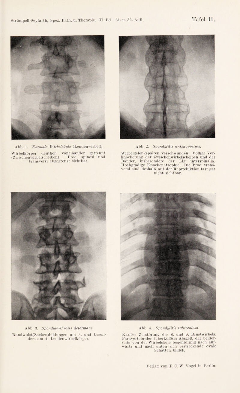 Strümpell-Seyfarth, Spez. Path. u. Therapie. II. Bd. 31. u. 32. Aufl. Tafel II Abb. 1. Normale Wirbelsäule (Lendenwirbel). Wirbelkörper deutlich voneinander getrennt (Zwischenwirbelscheiben). Proc. spinosi und transversi abgegrenzt sichtbar. Abb. 3. Spondylarthrosis deformans. Randwulst(Zacken)bildungen am 3. und beson¬ ders am 4. Lendenwirbelkörper. Abb. 2. Spondylitis anlcylopoetica. Wirbelgelenkspalten verschwunden. Völlige Ver¬ knöcherung der Zwischenwirbelscheiben und der Bänder, insbesondere der Lig. interspinalia. Hochgradige Knochenatrophie. Die Proc. trans¬ versi sind deshalb auf der Reproduktion fast gar nicht sichtbar. Abb. 4. Spondylitis tuberculosa. Kariöse Zerstörung des 8. und 9. Brustwirbels. Paravertebraler tuberkulöser Abszeß, der beider¬ seits von der Wirbelsäule bogenförmig nach auf¬ wärts und nach unten sich erstreckende ovale Schatten bildet. Verlag von F.C.W. Vogel in Berlin.