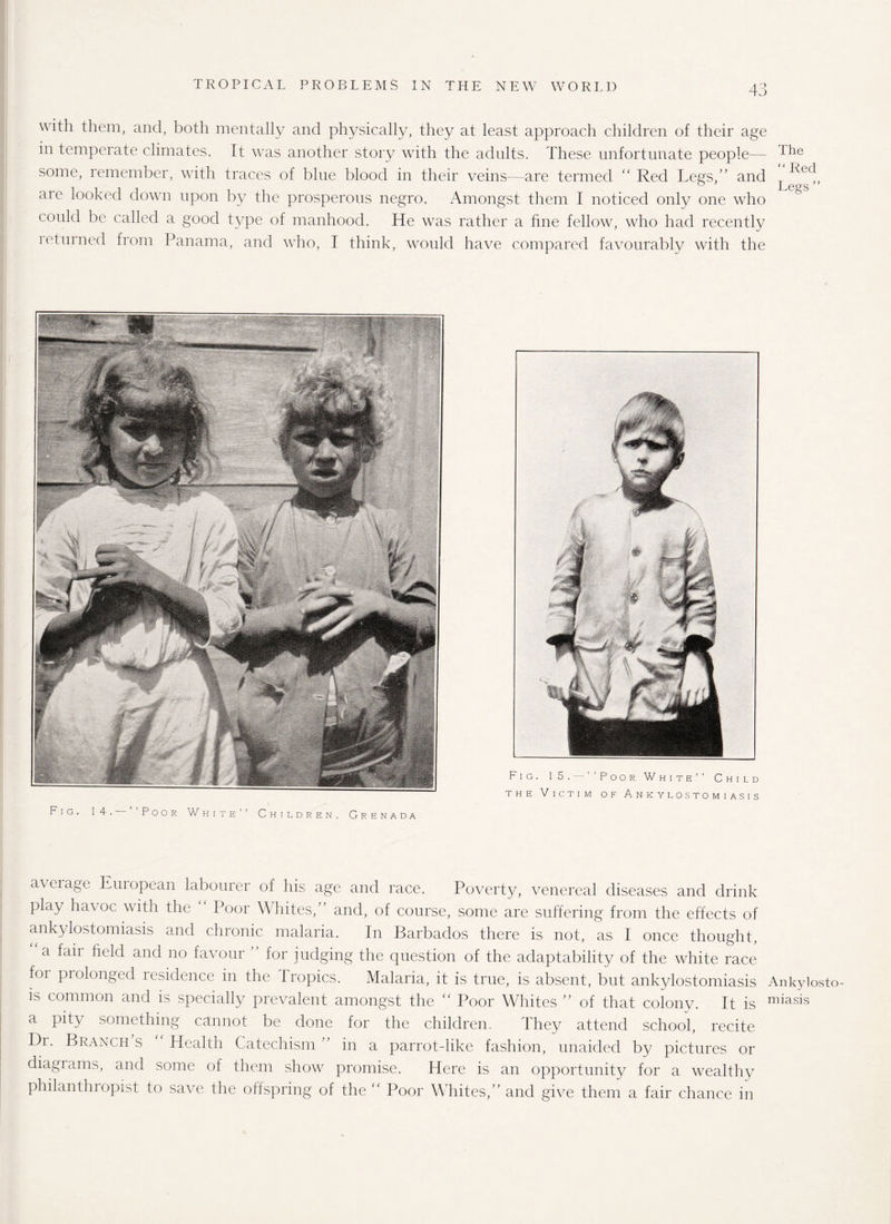 with them, and, both mentally and physically, they at least approach children of their age in temperate climates. It was another story with the adults. These unfortunate people— some, remember, with traces of blue blood in their veins—are termed “Red Legs,” and ^ ^cd, aie looked down upon by the prosperous negro. Amongst them I noticed only one who could be called a good t}^pe of manhood. He was rather a fine fellow, who had recently returned from Panama, and who, I think, would have compared favourably with the Fig. 14. Poor White Children, Grenada Fig. 15. —‘‘Poor White’’ Child the Victim of Ankylostomiasis aveiage Euiopean labourer of his age and race. Poverty, venereal diseases and drink play havoc with the Poor Whites,” and, of course, some are suffering from the effects of ankylostomiasis and chronic malaria. In Barbados there is not, as I once thought, a fail field and no favour for judging the question of the adaptability of the white race foi prolonged residence in the Tropics. Malaria, it is true, is absent, but ankylostomiasis Ankylosto- is common and is specially prevalent amongst the “ Poor Whites ” of that colony. It is miasis a pity something cannot be done for the children. They attend school, recite Di. Branchs Health Catechism” in a parrot-like fashion, unaided by pictures or diagrams, and some of them show promise. Here is an opportunity for a wealthy philanthropist to save the offspring of the “ Poor Whites,” and give them a fair chance in