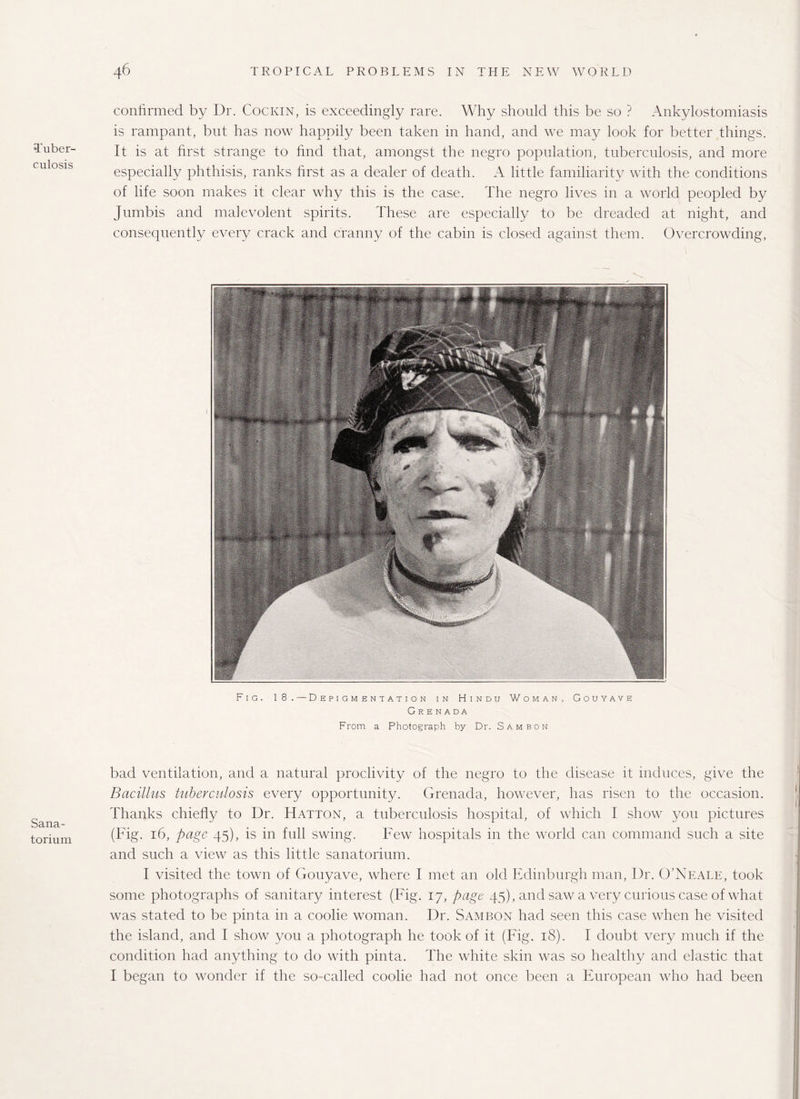 Tuber¬ culosis confirmed by Dr. Cockin, is exceedingly rare. Why should this be so ? Ankylostomiasis is rampant, but has now happily been taken in hand, and we may look for better things. It is at first strange to find that, amongst the negro population, tuberculosis, and more especially phthisis, ranks first as a dealer of death. A little familiarity with the conditions of life soon makes it clear why this is the case. The negro lives in a world peopled by Jumbis and malevolent spirits. These are especially to be dreaded at night, and consequently every crack and cranny of the cabin is closed against them. Overcrowding, Fig. 18. — Depigmentation in Hindu Woman, Gouyave Grenada From a Photograph by Dr. Sam bon Sana¬ torium bad ventilation, and a natural proclivity of the negro to the disease it induces, give the Bacillus tuberculosis every opportunity. Grenada, however, has risen to the occasion. Thanks chiefly to Dr. Hatton, a tuberculosis hospital, of which I show you pictures (Fig. 16, page 45), is in full swing. Few hospitals in the world can command such a site and such a view as this little sanatorium. I visited the town of Gouyave, where I met an old Edinburgh man, Dr. O’Neale, took some photographs of sanitary interest (Fig. 17, page 45), and saw a very curious case of what was stated to be pinta in a coolie woman. Dr. Sambon had seen this case when he visited the island, and I show you a photograph he took of it (Fig. 18). I doubt very much if the condition had anything to do with pinta. The white skin was so healthy and elastic that I began to wonder if the so-called coolie had not once been a European who had been