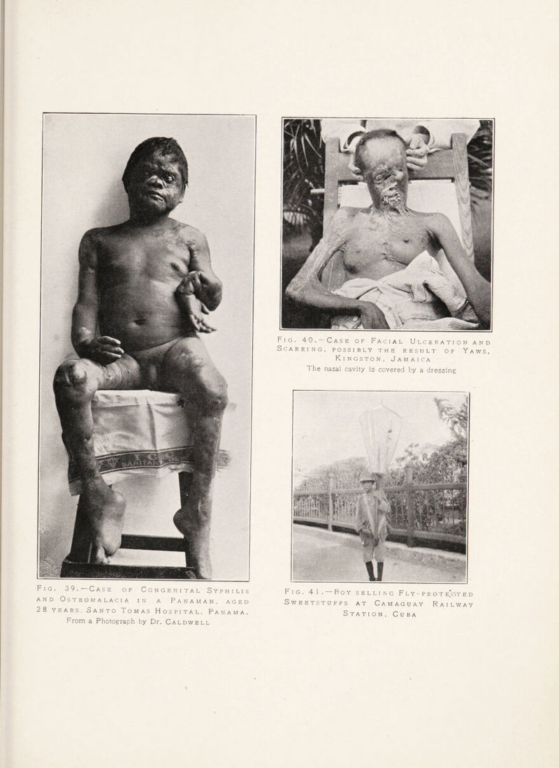 Fig. 39. Case of Congenital Syphilis and Osteomalacia in a Panaman, aged 28 years, Santo Tomas Hospital, Panama. From a Photograph by Dr. Caldwell Fig. 4 1. Boy selling Fly-prot e[c!t e d Sweetstuffs at Camaguay Railway Station, Cuba Fig. 40. Case of Facial Ulceration and Scarring, possibly the result of Yaws, Kingston, Jamaica The nasal cavity is covered by a dressing