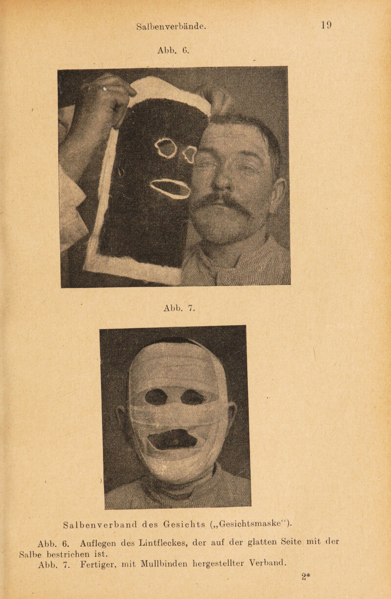 Abb. G. Abb. 7. Salben verband des Gesichts („Gesichtsmaske“). Abb. 6. Auflegen des Lintfleckes, der auf der glatten Seite mit der Salbe bestrichen ist. Abb. 7. Fertiger, mit Mullbinden hergestellter Verband. 2*