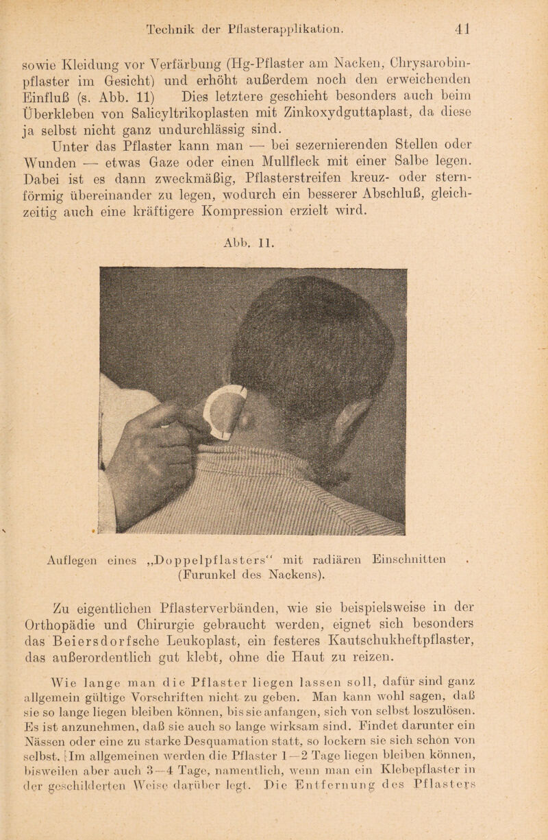 sowie Kleidung vor Verfärbung (Hg-Pflaster am Nacken, Chrysarobin- pflaster im Gesicht) und erhöht außerdem noch den erweichenden Einfluß (s. Abb. 11) Dies letztere geschieht besonders auch beim Überkleben von Salicyltrikoplasten mit Zinkoxydguttaplast, da diese ja selbst nicht ganz undurchlässig sind. Unter das Pflaster kann man — bei sezernierenden Stellen oder Wunden — etwas Gaze oder einen Mullfleck mit einer Salbe legen. Dabei ist es dann zweckmäßig, Pflasterstreifen kreuz- oder stern¬ förmig übereinander zu legen, wodurch ein besserer Abschluß, gleich¬ zeitig auch eine kräftigere Kompression erzielt wird. Abb. 11. Auflegen eines „Doppelpflasters mit radiären Einschnitten (Furunkel des Nackens). Zu eigentlichen Pflasterverbänden, wie sie beispielsweise in der Orthopädie und Chirurgie gebraucht werden, eignet sich besonders das Beiersdorf sehe Leukoplast, ein festeres Kautschukheftpflaster, das außerordentlich gut klebt, ohne die Haut zu reizen. Wie lange man die Pflaster liegen lassen soll, dafür sind ganz allgemein gültige Vorschriften nicht zu geben. Man kann wohl sagen, daß sie so lange liegen bleiben können, bis sie anfangen, sich von selbst loszulösen. Es ist anzunehmen, daß sie auch so lange wirksam sind. Findet darunter ein Nässen oder eine zu starke Desquamation statt, so lockern sie sich schon von selbst. \Im allgemeinen werden die Pflaster 1—2 Tage liegen bleiben können, bisweilen aber auch 3—4 Tage, namentlich, wenn man ein Klebepflaster in der geschilderten Weise darüber legt. Die Entfernung des Pflasters