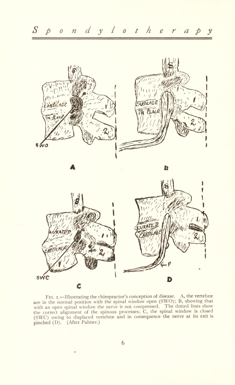 B swc Fig. i.—Illustrating the chiropractor’s conception of disease. A, the vertebrae are in the normal position with the spinal window open (SWO); B, showing that with an open spinal window the nerve is not compressed. The dotted lines show the correct alignment of the spinous processes; C, the spinal window is closed (SWC) owing to displaced vertebra; and in consequence the nerve at its exit is pinched (D). (After Palmer.)