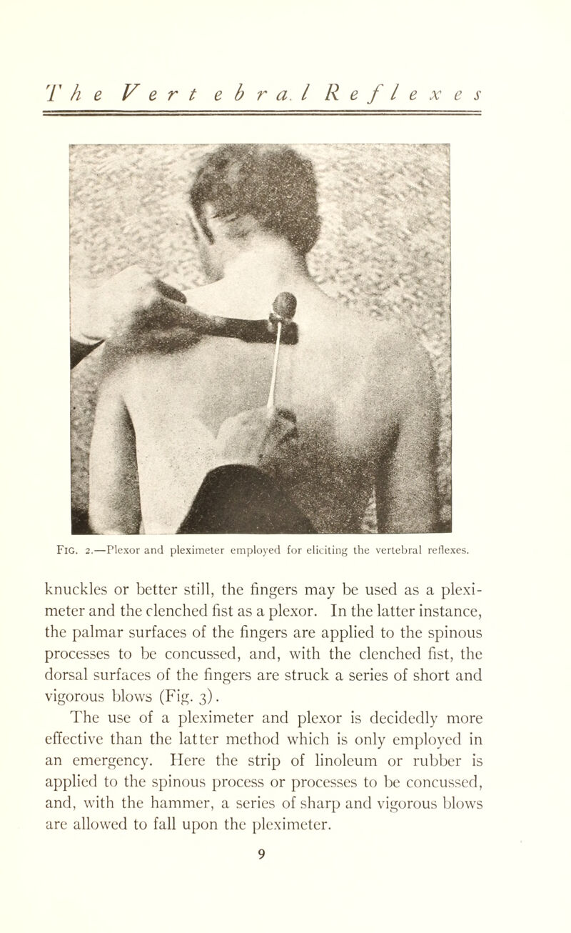 The Vert e b r a. I Reflexes Fig. 2.—Plexor and pleximeter employed for eliciting the vertebral reflexes. knuckles or better still, the fingers may be used as a plexi¬ meter and the clenched fist as a plexor. In the latter instance, the palmar surfaces of the fingers are applied to the spinous processes to be concussed, and, with the clenched fist, the dorsal surfaces of the fingers are struck a series of short and vigorous blows (Fig. 3). The use of a pleximeter and plexor is decidedly more effective than the latter method which is only employed in an emergency. Here the strip of linoleum or rubber is applied to the spinous process or processes to be concussed, and, with the hammer, a series of sharp and vigorous blows are allowed to fall upon the pleximeter.