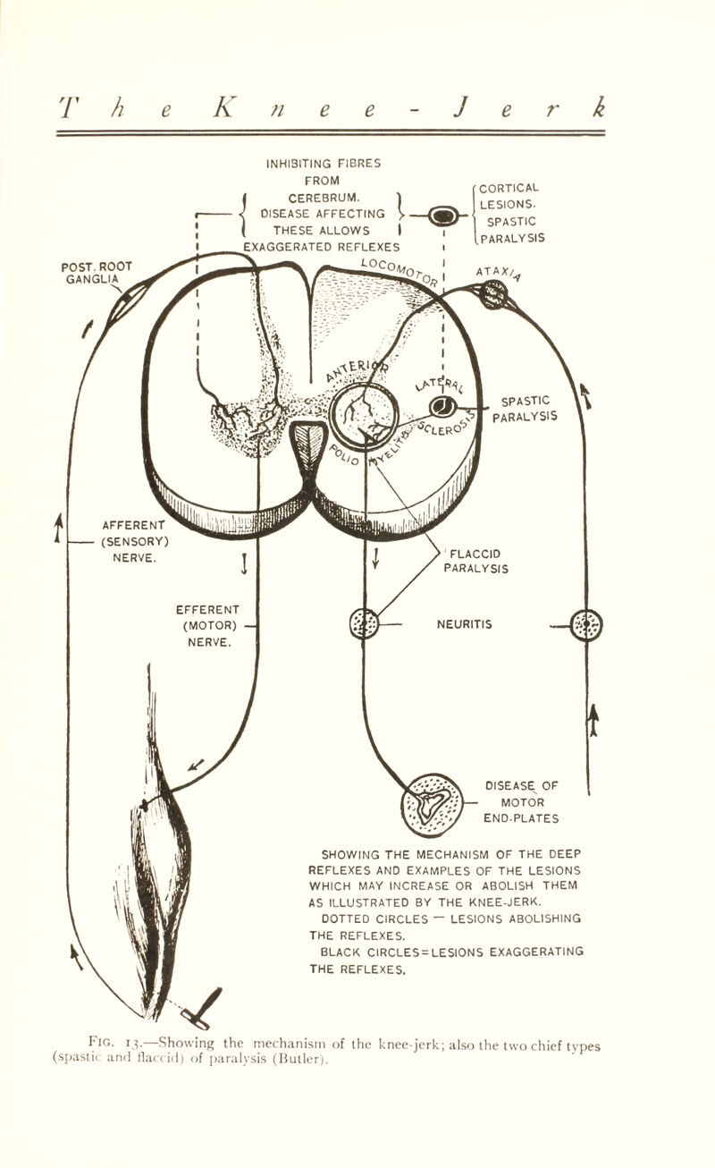 POST. ROOT GANGLIA N INHIBITING FIBRES FROM I CEREBRUM. 1 X DISEASE AFFECTING > CORTICAL LESIONS. SPASTIC .PARALYSIS SHOWING THE MECHANISM OF THE DEEP REFLEXES AND EXAMPLES OF THE LESIONS WHICH MAY INCREASE OR ABOLISH THEM AS ILLUSTRATED BY THE KNEE-JERK. DOTTED CIRCLES ~ LESIONS ABOLISHING THE REFLEXES. BLACK CIRCLES^ LESIONS EXAGGERATING THE REFLEXES. Fw. 13.—Showing the mechanism of the knee-jerk; also the two chief types (spastic and flaccid) of paralysis (Butler).