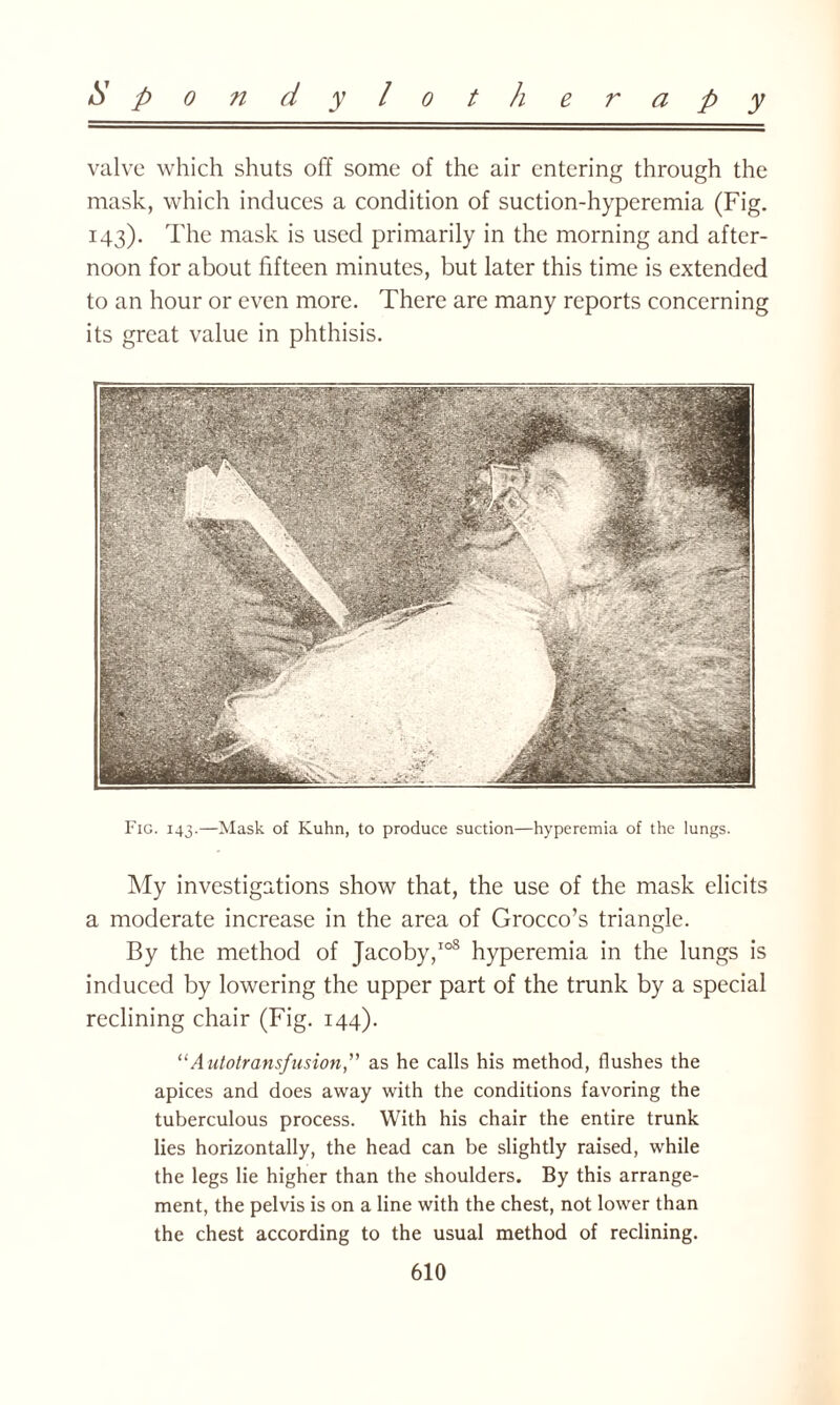 valve which shuts off some of the air entering through the mask, which induces a condition of suction-hyperemia (Fig. 143). The mask is used primarily in the morning and after¬ noon for about fifteen minutes, but later this time is extended to an hour or even more. There are many reports concerning its great value in phthisis. Fig. 143.—Mask of Kuhn, to produce suction—hyperemia of the lungs. My investigations show that, the use of the mask elicits a moderate increase in the area of Grocco’s triangle. By the method of Jacoby,108 hyperemia in the lungs is induced by lowering the upper part of the trunk by a special reclining chair (Fig. 144). “Autotransfusion,” as he calls his method, flushes the apices and does away with the conditions favoring the tuberculous process. With his chair the entire trunk lies horizontally, the head can be slightly raised, while the legs lie higher than the shoulders. By this arrange¬ ment, the pelvis is on a line with the chest, not lower than the chest according to the usual method of reclining.
