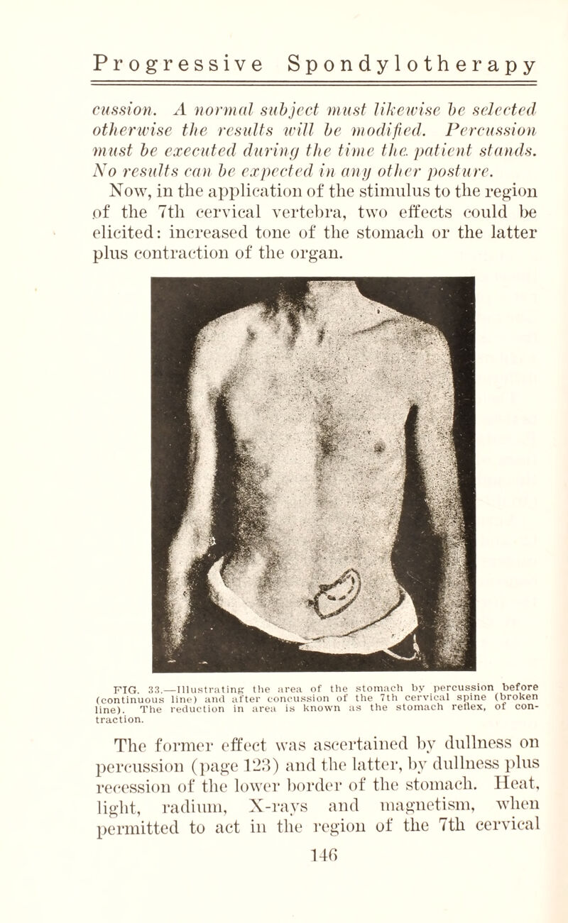 cussion. A normal subject must likewise be selected otherwise the results will be modified. Percussion must be executed during the time the. patient stands. No results can be expected in any other posture. Now, in the application of the stimulus to the region of the 7th cervical vertebra, two effects could be elicited: increased tone of the stomach or the latter plus contraction of the organ. FIG. 33.—Illustrating the area of the stomach by percussion before (continuous line) and after concussion of the 7th cervical spine (broken line). The reduction in area is known as the stomach reflex, ot con¬ traction. The former effect was ascertained by dullness on percussion (page 123) and the latter, by dullness plus recession of the lower border of the stomach. Heat, light, radium, X-rays and magnetism, when permitted to act in the region of the 7th cervical