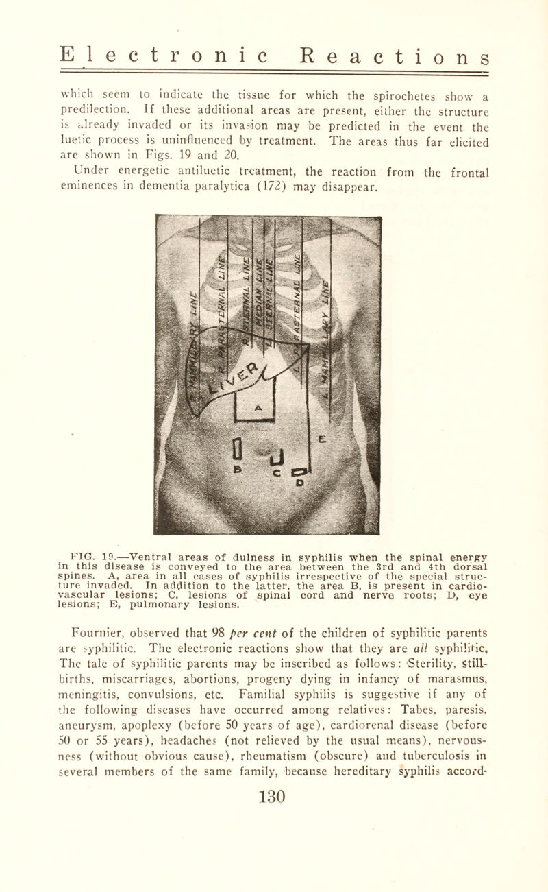 which seem to indicate the tissue for which the spirochetes show a predilection. If these additional areas are present, either the structure is already invaded or its invasion may be predicted in the event the luetic process is uninfluenced by treatment. The areas thus far elicited are shown in Figs. 19 and 20. Under energetic antiluetic treatment, the reaction from the frontal eminences in dementia paralytica (172) may disappear. FIG. 19.—Ventral areas of dulness in syphilis when the spinal energy in this disease is conveyed to the area between the 3rd and 4th dorsal spines. A, area in all cases of syphilis irrespective of the special struc¬ ture invaded. In addition to the latter, the area B, is present in cardio¬ vascular lesions; C, lesions of spinal cord and nerve roots; D, eye lesions; E, pulmonary lesions. Fournier, observed that 98 per cent of the children of syphilitic parents are syphilitic. The electronic reactions show that they are all syphilitic. The tale of syphilitic parents may be inscribed as follows: Sterility, Still¬ births, miscarriages, abortions, progeny dying in infancy of marasmus, meningitis, convulsions, etc. Familial syphilis is suggestive if any of the following diseases have occurred among relatives: Tabes, paresis, aneurysm, apoplexy (before 50 years of age), cardiorenal disease (before 50 or 55 years), headaches (not relieved by the usual means), nervous¬ ness (without obvious cause), rheumatism (obscure) and tuberculosis in several members of the same family, because hereditary syphilis accord-