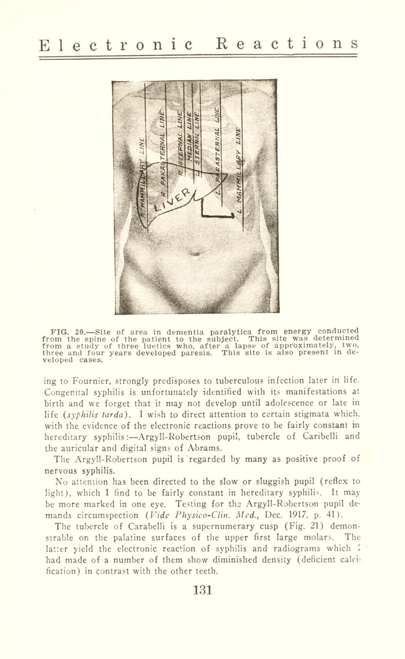 FIG. 20.—Site of area in dementia paralytica from energy conducted from the spine of the patient to the subject. This site was determined from a study of three luetics who, after a lapse of approximately, two, three and four years developed paresis. This site is also present in de¬ veloped cases. ing to Fournier, strongly predisposes to tuberculous infection later in life. Congenital syphilis is unfortunately identified with its manifestations at birth and we forget that it may not develop until adolescence or late in life (syphilis tarda). I wish to direct attention to certain stigmata which, with the evidence of the electronic reactions prove to be fairly constant in hereditary syphilis:—Argyll-Robertson pupil, tubercle of Caribelli and the auricular and digital signs of Abrams. The Argyll-Robertson pupil is regarded by many as positive proof of nervous syphilis. No attention has been directed to the slow or sluggish pupil (reflex to light), which I find to be fairly constant in hereditary syphilis. It may be more marked in one eye. Testing for the Argyll-Robertson pupil de¬ mands circumspection (Vide Physico-Clin. Med., Dec. 1917, p. 41). The tubercle of Carabelli is a supernumerary cusp (Fig. 21) demon¬ strable on the palatine surfaces of the upper first large molars. The latter yield the electronic reaction of syphilis and radiograms which I had made of a number of them show diminished density (deficient calci¬ fication) in contrast with the other teeth.