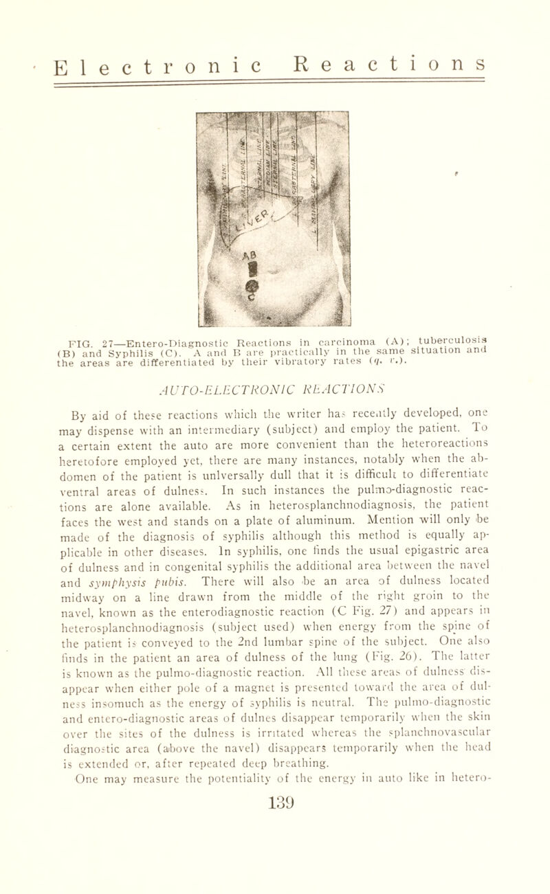 FIG. 27—Entero-Diagnostic Reactions in carcinoma (A); tuberculosis (B) and Syphilis (C). A and B are practically in the same situation and the areas are differentiated by their vibratory rates (</. r.). AUTO-ELECTRONIC REACTIONS By aid of these reactions which the writer has recently developed, one may dispense with an intermediary (subject) and employ the patient. To a certain extent the auto are more convenient than the heteroreactions heretofore employed yet, there are many instances, notably when the ab¬ domen of the patient is universally dull that it is difficult to differentiate ventral areas of dulnes?. In such instances the pulmo-diagnostic reac¬ tions are alone available. As in heterosplanchnodiagnosis, the patient faces the west and stands on a plate of aluminum. Mention will only he made of the diagnosis of syphilis although this method is equally ap¬ plicable in other diseases. In syphilis, one finds the usual epigastric area of dulness and in congenital syphilis the additional area between the navel and symphysis pubis. There will also he an area of dulness located midway on a line drawn from the middle of the right groin to the navel, known as the enterodiagnostic reaction (C Fig. 27) and appears in heterosplanchnodiagnosis (subject used) when energy from the spine of the patient is conveyed to the 2nd lumbar spine of the subject. One also finds in the patient an area of dulness of the lung (Fig. 26). The latter is known as the pulmo-diagnostic reaction. All these areas of dulness dis¬ appear when either pole of a magnet is presented toward the area of dul¬ ness insomuch as the energy of syphilis is neutral. The pulmo-diagnostic and entero-diagnostic areas of dulnes disappear temporarily when the skin over the sites of the dulness is irritated whereas the splanehnovascular diagnostic area (aibove the navel) disappears temporarily when the head is extended or, after repeated deep breathing. One may measure the potentiality of the energy in auto like in hetero-