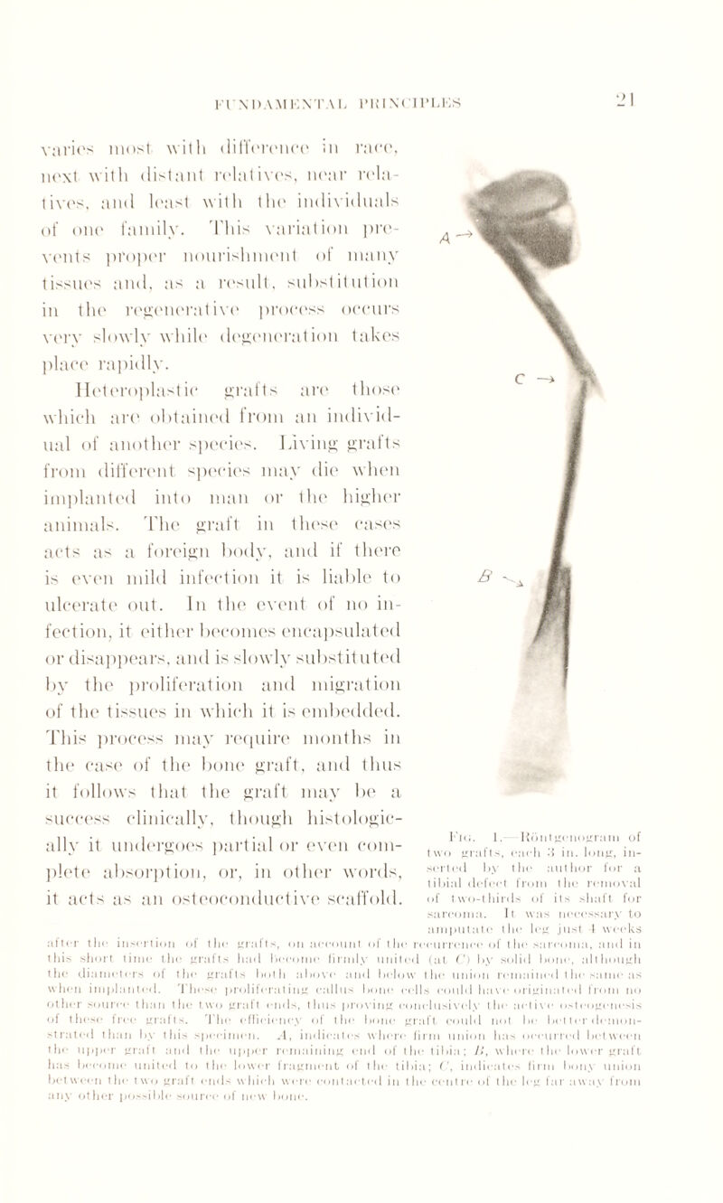 FI' N DAM KN'TA I, PH IN< IPLKS varies most with dilToivnce in race, next with distant relatives, near rela¬ tives, and least with the individuals of one family. This variation pre¬ vents proper nourishment of many tissues and, as a result, substitution in the regenerative process occurs very slowly while degeneration takes place rapidly. Heteroplastic grafts are those which are obtained from an individ¬ ual of another species. Living grafts from different species may die when implanted into man or the higher animals. The graft in these cases acts as a foreign body, and if there is even mild infection it is liable to ulcerate out. In the event of no in¬ fection, it either becomes encapsulated or disappears, and is slowly substituted by the proliferation and migration of the tissues in which it is embedded. This process may require months in the case of the bone graft, and thus it follows that the graft may be a success clinically, though histologic¬ ally it undergoes partial or even com¬ plete absorption, or, in other words, it acts as an osteoconductive scaffold. after tin- insertion of the Krafts, on account of the recurrence of the sarcoma, and in this short time the grafts had become firmly united (at C) by solid bone, although the diameters of the grafts both above and below the union remained the same as when implanted. These proliferating callus bone cells could have originated from no other source than the two graft ends, thus proving conclusively the active osteogenesis of these free grafts. I ho efficiency of the bone graft could not be bet ter demon¬ strated than by this specimen. A, indicates where firm union Inis occurred between the upper graft and the upper remaining end of the tibia; />’, when; the lower graft has become united to the lower fragment of the tibia; (', indicates firm bony union between the two graft ends which were contacted in the centre of the leg far away from any other possible source of new bone. Flu. 1, Rbntgenogram of two grafts, each -'i in. long, in¬ serted l>,\ the author for a tibial defect from the removal of two-thirds of its shaft for sarcoma. It was necessary to amputate the leg just i weeks