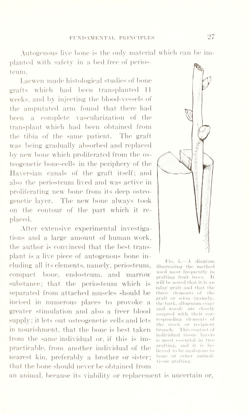 Autogenous live hono is the only material which can he im- planted with safety in a hod IVee of perios- tenm. Laewen made histological studies ol hone grafts which had heen trans])lanted II weeks, and by injecting the blood-vessels of the amputated arm found that there had been a complete vascularization of the transplant which had heen obtained from the tibia of the same patient. The graft was being gradually absorbed and replaced by new bone which proliferated from the <>s- teogenetic bone-cells in the periphery of the Haversian canals of the graft itself; and also the periosteum lived and was active in proliferating new bone from its deep osteo- genetic layer. The new hone always took on the contour of the part which it re¬ placed. After extensive experimental investiga¬ tions and a large amount of human work, the author is convinced that the best trans¬ plant is a live piece of autogenous hone in¬ cluding all its elements, namely, periosteum, compact hone, endosteum, and marrow substance; that Ihe periosteum which is separated from attached muscles should he incised in numerous places to provoke a greater stimulation and also a freer blood supply; it lets out osteogenetic culls and lets in nourishment, that the hone is best taken from the same individual or, if this is im¬ practicable, from another individual of the nearest kin, preferably a brother or sister; that the bone should never he obtained from an animal, because its viability or replacement is uncertain or, Fig. .A.—A diagram illustrating the method used most frequently in grafting fruit trees. It will ho noted that it. is an inlay graft and that the three elements of the graft or scion (namely, t he bark, alburnum (sap) and wood) are closely eoapted with their cor¬ responding elements of t he stock or recipient branch. This contact of individual tissue layers is most cssenl ial in t roe grafting, and it. is be¬ lieved to be analogous to bone or ot her animal- tissue grafting.