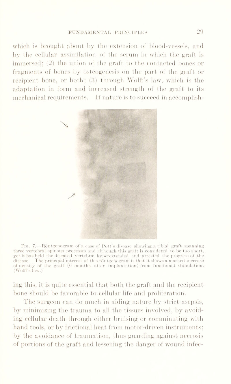 FUNDAMENTAL PRINCIPLES 20 which is brought about by the extension of blood-vessels, and by tin' cellular assimilation of th(‘ serum in which the graft is immersed; (2) the union of the graft to the contacted bones or fragments of bones by osteogenesis on tin' part of the graft or recipient bone, or both; (3) through Wolffs law, which is the adaptation in form and increased strength of the graft to its mechanical requirements. If nature is to succeed in accomplish- Fig. 7.—Rdntgenogram of a case of Pott’s disease showing a tibial graft spanning three vertebral spinous processes and although this graft is considered to be too short, yet it has held the diseased vertebra; hyperextended and arrested the progress of the disease. The principal interest of this rdntgenogram is that it shows a marked increase of density of the graft (0 months after implantation) from functional stimulation. (Wolff’s iaw.) ing this, it is quite essential that both tin1 graft and the recipient bone should be favorable to cellular life and proliferation. The surgeon can do much in aiding nature by strict asepsis, by minimizing the trauma to all the tissues involved, by avoid¬ ing cellular death through either bruising or comminuting with hand tools, or by frictional heat from motor-driven instruments; by the avoidance of traumatism, thus guarding against necrosis of portions of the graft and lessening the danger of wound infec-