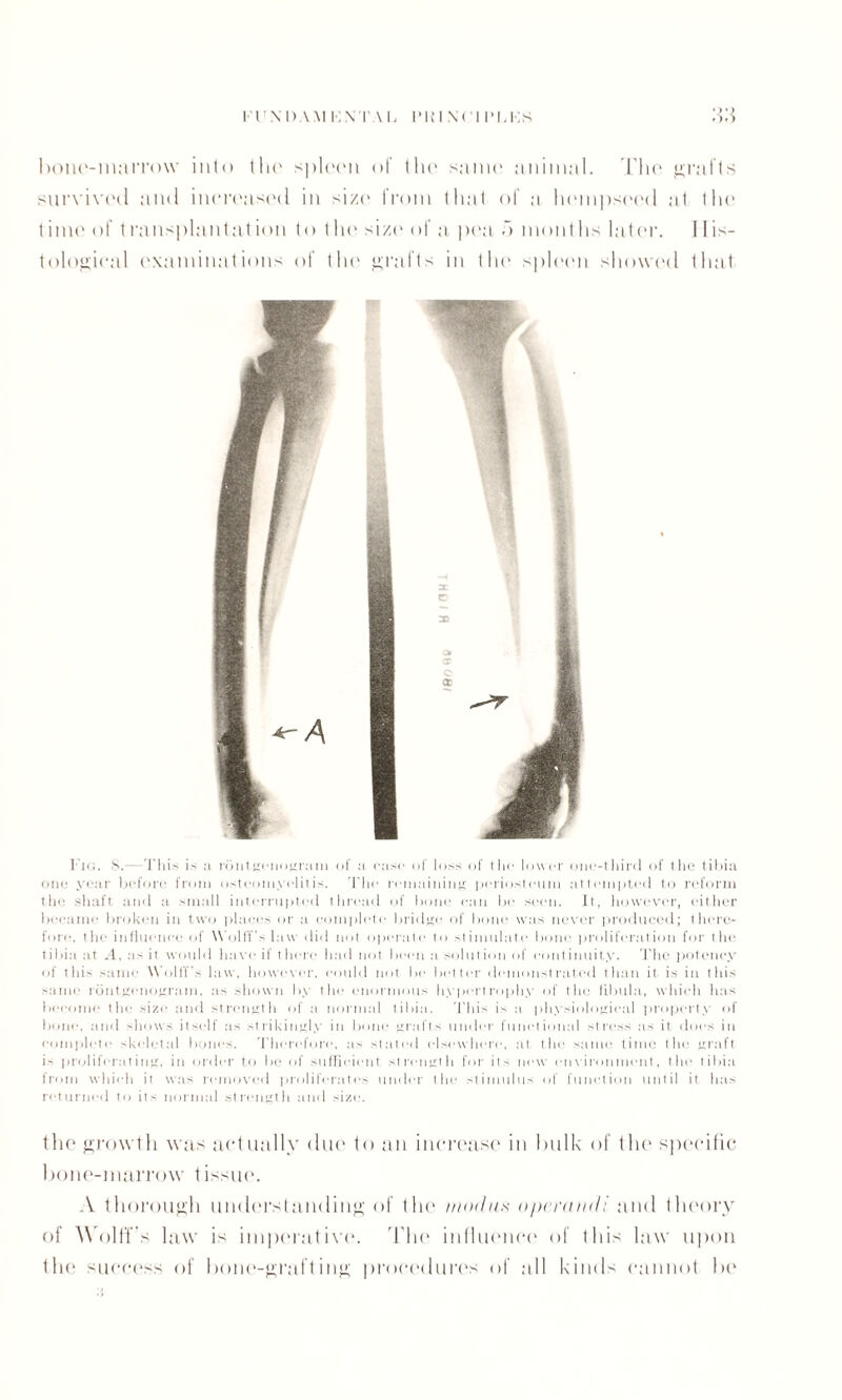 bone-marrow into the spleen of the same animal. The grafts survived and increased in size from that of a hempseed at tin* time of transplantation to tin1 size of a pea .”> months later. His¬ tological examinations of the grafts in the spleen showed that 1’ig. S.—This is a rbntgenogram of a case of loss of the lower one-third of (he tibia one year before from osteomyelitis. The remaining periosteum attempted to reform the shaft and a small interrupted thread of bone can be seen. It, however, either became broken in two places or a complete bridge of bone was never produced; there¬ fore, the influence of Wolff’s law did not operate to stimulate bone proliferation for the tibia at A, as it would have if there had not been a solution of continuity. The potency of this same Wolff's law, however, could not be better demonstrated than it is in this same rontgenognun, as shown by the enormous hypertrophy of the fibula, which has become the size and strength of a normal tibia. This is a physiological property of bone, and shows itself as strikingly in bone grafts under functional stress as it does in complete skeletal bones. Therefore, as stated elsewhere, at the same time the graft is proliferating, in order to be of sufficient strength for its new environment, the tibia from which it was removed proliferates under the stimulus of function until it has returned to its normal strength and size. the growth was actually duo to an increase in bulk of the specific bone-marrow t issue. A thorough understanding of the modus operand: and theory of Wolff's law is imperative. The influence of this law upon the success of bone-grafting procedures of till kinds cannot be