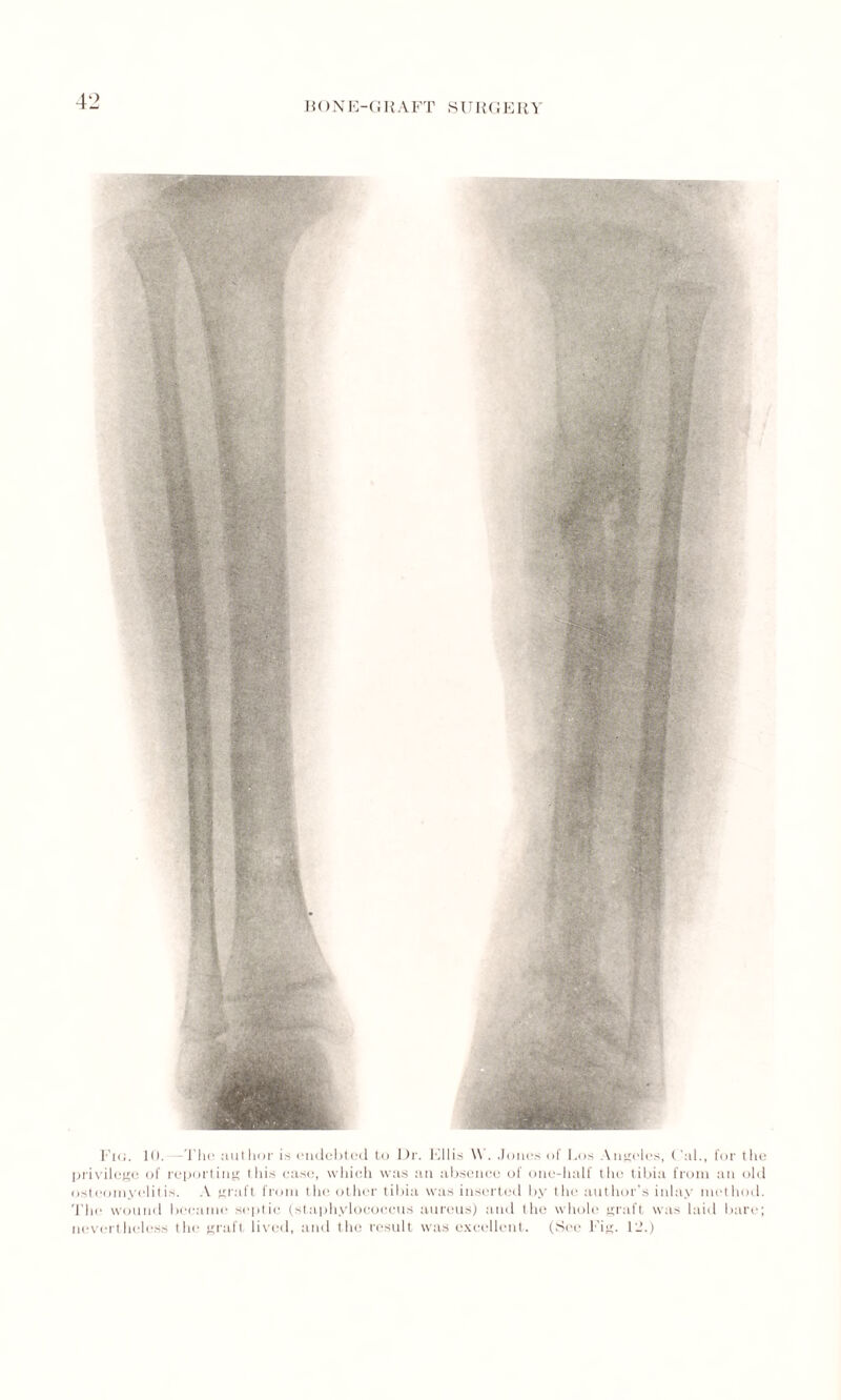 Fig. 10. I’hc author is (indebted to Dr. Ellis AN . Jones of Los Angeles, Cal., for the privilege of reporting this case, which was an absence of one-half the tibia from an old osteomyelitis. A graft from the other tibia was inserted by the author’s inlay met hod. The wound became septic (staphylococcus aureus) and the whole graft was laid bare; nevertheless the graft lived, and the result was excellent. (See Fig. 12.)