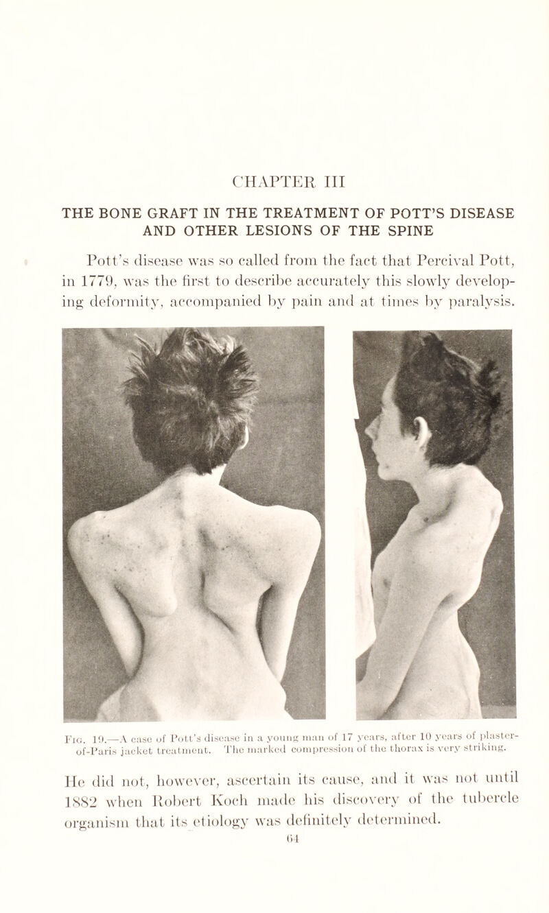 CHAPTER III THE BONE GRAFT IN THE TREATMENT OF POTT’S DISEASE AND OTHER LESIONS OF THE SPINE Pott’s disease was so called from the fact that Percival Pott, in 1779, was the first to describe accurately this slowly develop¬ ing deformity, accompanied by pain and at times by paralysis. Fig. 19.—A case of Pott’s disease in a young man of 17 years, after 10 years of plaster- of-Paris jacket treatment. The marked compression of the thorax is very striking. He did not, however, ascertain its cause, and it was not until 1882 when Robert Koch made his discovery of the tubercle organism that its etiology was definitely determined.