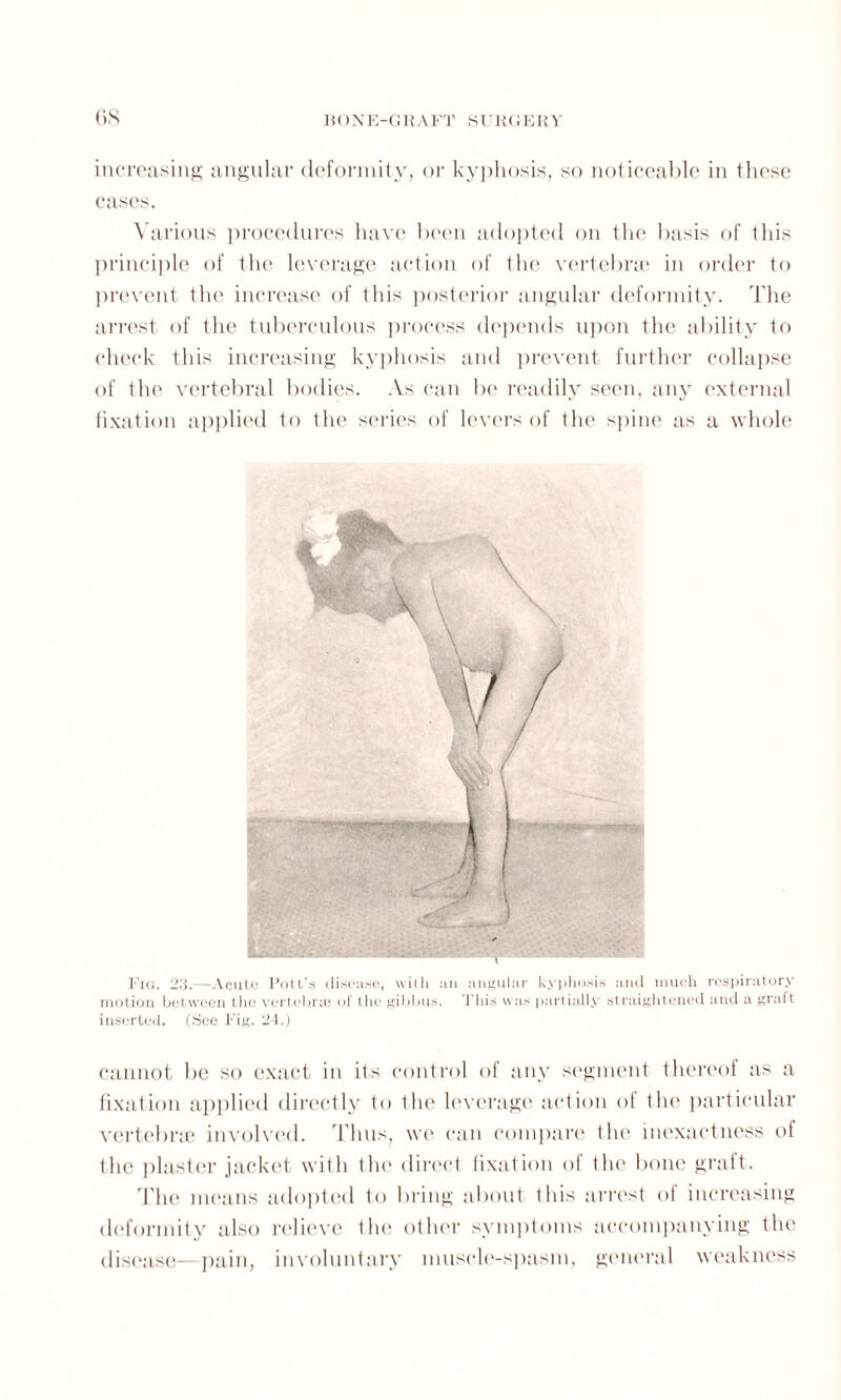 (>S BON E-GIt A FT SURGERY increasing angular deformity, or kyphosis, so noticeable in these cases. Various procedures have been adopted on the basis of this principle of the leverage action of the vertebrae in order to prevent the increase of this posterior angular deformity. The arrest of the tuberculous process depends upon the ability to check this increasing kyphosis and prevent further collapse of the vertebral bodies. As can be readily seen, any external fixation applied to the series of levers of the spine as a whole Fig. 23.—Acute Pott’s disease, with an angular kyphosis and much respiratory motion between the vertebras of the gibbus. This was partially straightened and a graft inserted. (See Fig. 24.) cannot be so exact in its control of any segment thereof as a fixation applied directly to the leverage action of the particular the plaster jacket with the direct fixation of the bone graft. The means adopted to bring about this arrest of increasing deformity also relieve the other symptoms accompanying the