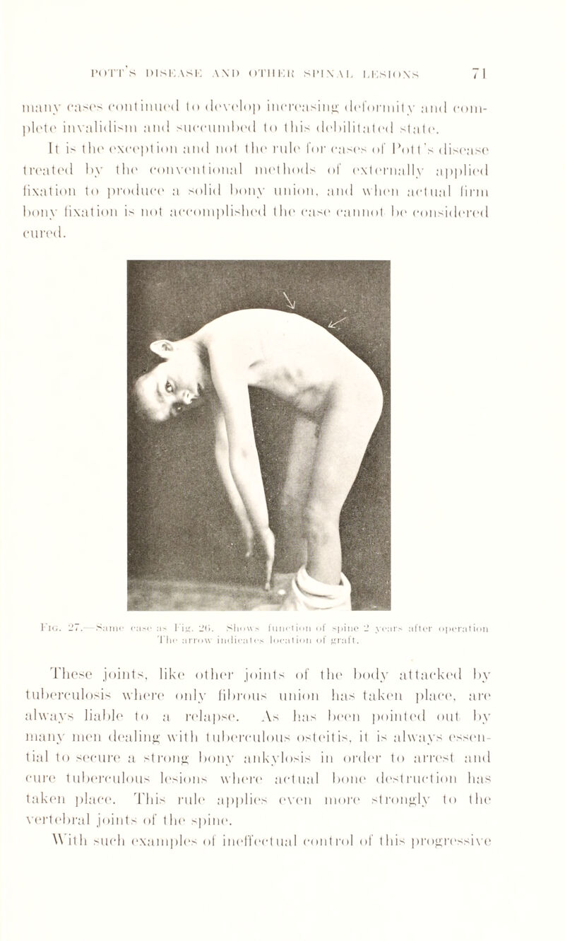 many cases continued to develop increasing deformity and com¬ plete invalidism and succumbed to this debilitated state. 11 is tin' except ion and not t he rule for cases of Pot t s disease treated by the conventional methods of externallv applied fixation to produce a solid bony union, and when actual linn bony fixation is not accomplished the cast* cannot be considered cured. Fig. 27.—Same case as Tin. 2(1. Shows function of spine 2 years after operation The arrow indicates location of graft. These joints, like other joints of the body attacked by tuberculosis where only fibrous union 1ms taken place, art' always liable to a relapse. As Inis been pointed out by many men dealing with tuberculous osteitis, it is always essen¬ tial to secure a strong bony ankylosis in order to arrest and cure tuberculous lesions where actual bom* destruction has taken place. This rule applies even more strongly to the vertebral joints of the spine. With such examples of ineffectual control of this progressive