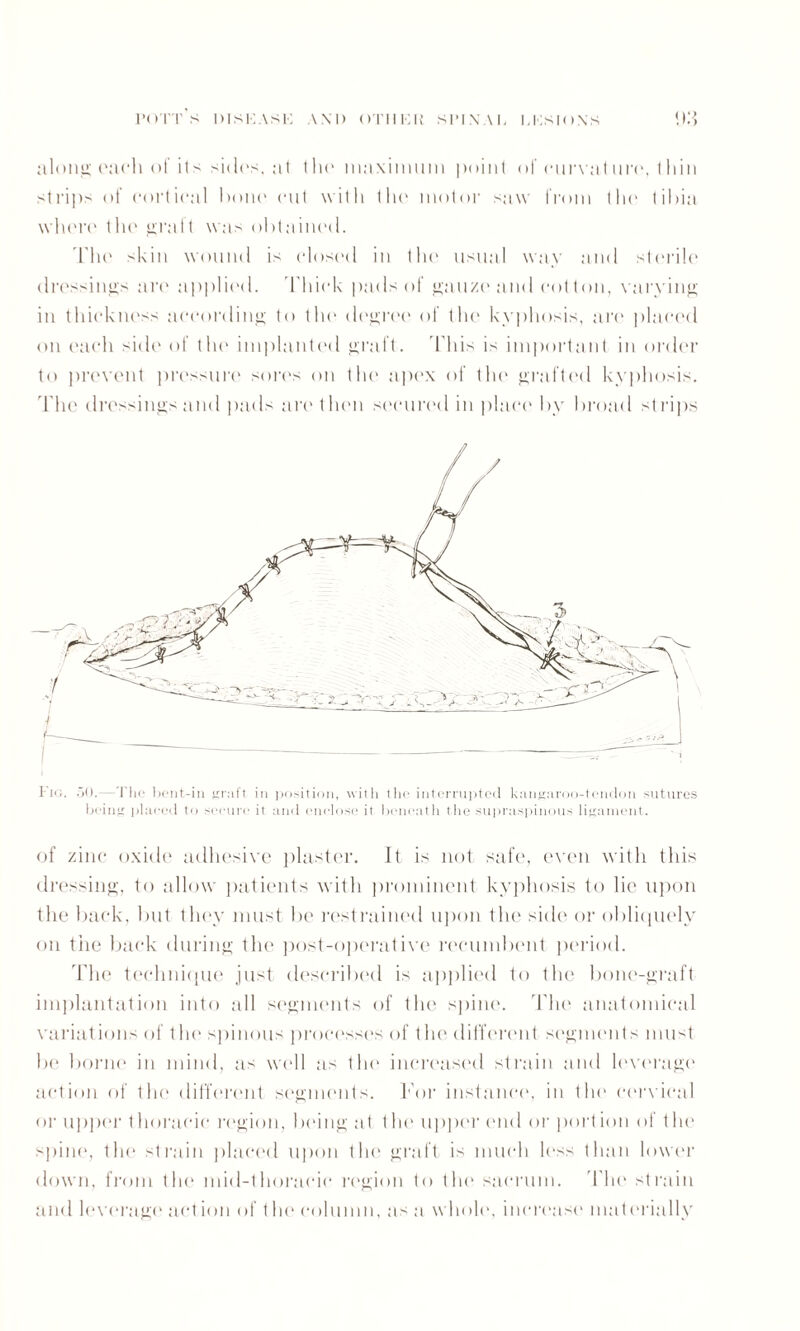 a lot hi; ('a eh of its sides, at tlu‘ maximum point of cur vat lire, t )i in strips of cortical bone cut with the motor saw from tin* tibia where the graft was obtained. The skin wound is closed in tho usual way and sterile dressings are applied. Thick pads of gauze and cot ton, varying in thickness according to the degree of the kyphosis, are placed on each side of the implanted graft. This is important in order to prevent pressure sores on the apex of the grafted kyphosis. The dressings and pads are then secured in place 1 >y broad st rips I'u;. .50.—The bent-in graft in position, with the interrupted kangaroo-tendon sutures being placed to secure it and enclose it beneath the supraspinous ligament. of zinc oxide adhesive plaster. It is not safe, even with this dressing, to allow patients with prominent kyphosis to lie upon the back, but they must be restrained upon the side' or obliquely on tiie back during the post-operative recumbent period. The technique just described is applied to the bone-graft implantation into all segments of the spine. The anatomical variations of the spinous processes of the different segments must be borne in mind, as well as the increased strain and leverage action of the different segments. For instance, in the cervical or upper thoracic region, being at the upper end or port ion of the spine, the strain placed upon the graft is much less than lower down, from the mid-thoracic region to the sacrum. 'The strain and leverage action of the column, as a whole, increase materially