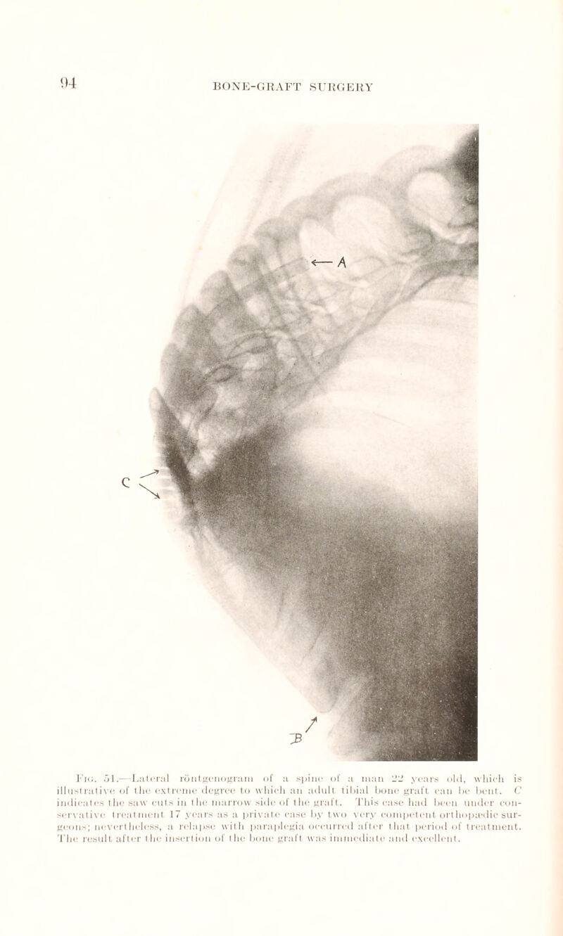 Fig. 51.—Lateral rontgenogram of a spine of a man 22 years old, which is illustrative of the extreme degree to which an adult tibial bone graft can be bent. C' indicates the saw cuts in the marrow side of the graft. This case had been under con¬ servative treatment 17 years as a private case by two very competent orthopaedic sur¬ geons; nevertheless, a relapse with paraplegia occurred after that period of treatment, t he result after the insertion of the bone graft was immediate and excellent.