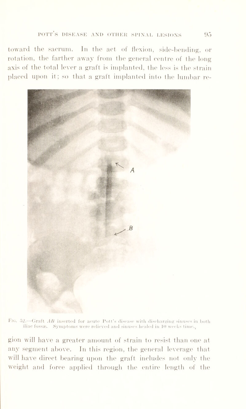 toward the sacrum. In tin1 act of flexion, side-bending, or rotation, the farther away from the general centre of the long a\i> of the total lever a graft is implanted, the less is tin' strain placed upon it; so that a graft implanted into the lumbar re- .>2.—Graft AIi inserted for acute Pott’s disease with discharging: sinuses in both ili ac fossa}. Symptoms were relieved and sinuses healed in lit weeks time., gion will have a greater amount of strain to resist than one at any segment above. In this region, the general leverage that will have direct bearing upon the graft includes not only the weight ttnd force applied through the* entire length of the