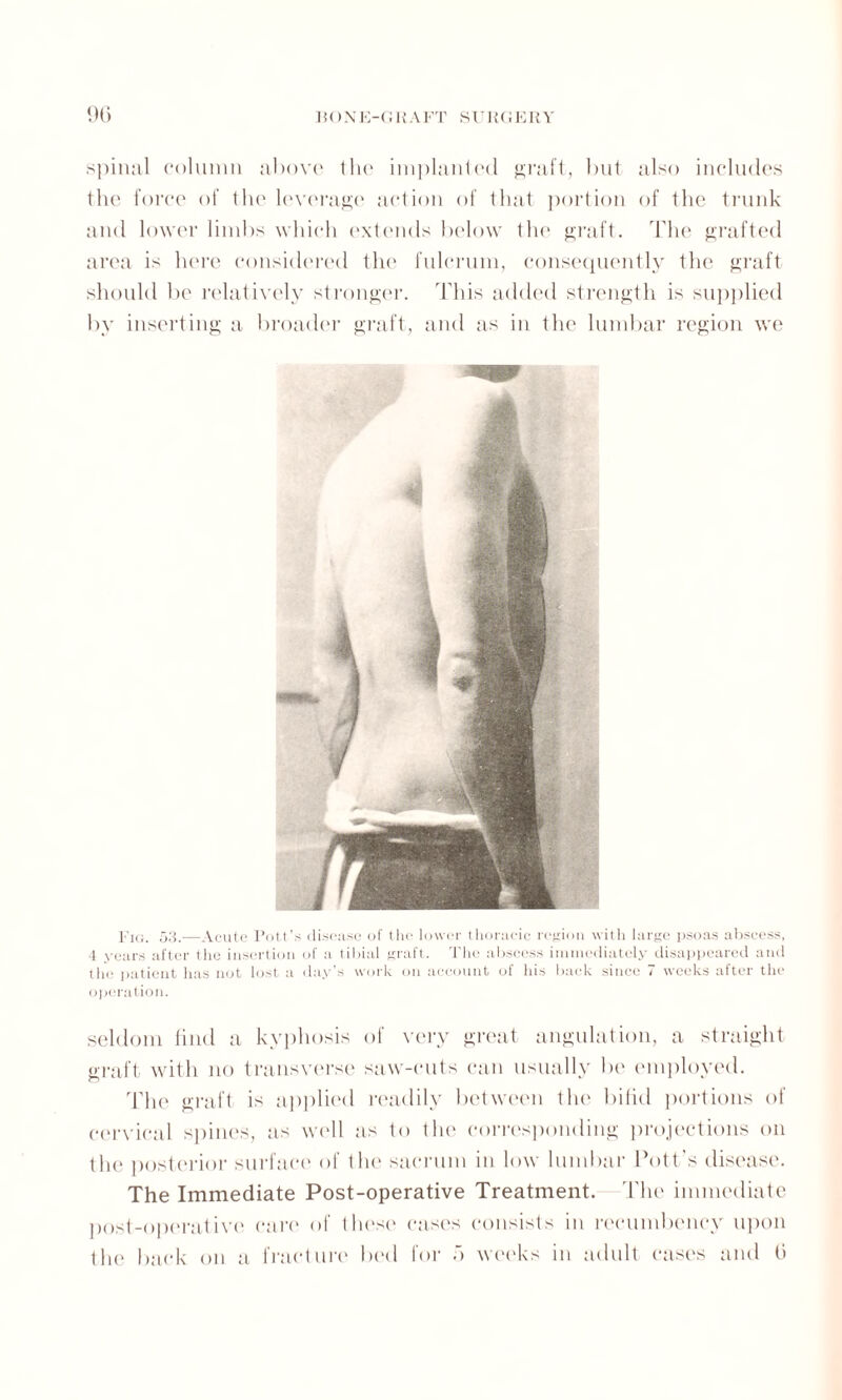 spinal column above the implanted graft, but also includes the force of the leverage action of that portion of the trunk and lower limbs which extends below the graft. The grafted area is here considered the fulcrum, consequently the graft should be relatively stronger. This added strength is supplied by inserting a broader graft, and as in the lumbar region we Pig. 53.—Acute Pott’s disease of the lower thoracic region with large psoas abscess, 4 years after the insertion of a tibial graft. The abscess immediately disappeared and the patient has not lost a day’s work on account of his back since 7 weeks after the operation. seldom find a kyphosis of very great angulation, a straight graft with no transverse saw-cuts can usually be employed. The graft is applied readily between the bifid portions of cervical spines, as well as to the corresponding projections on the posterior surface of the sacrum in low lumbar Pott’s disease. The Immediate Post-operative Treatment. The immediate post-operative care of I hose cases consists in recumbency upon the back on a fracture bed for f> weeks in adult cases and 6