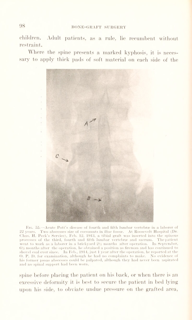 children. Adult patients, as a rule, lie recumbent without restraint. here the spine presents a marked kyphosis, it is neces¬ sary to apply thick pads of soft material on each side of the C l ie;. 55.—Acute Pott’s disease of fourth and fifth lumbar vertebra! in a laborer of 22 years. Two abscesses size of eocoanuts in iliac fossa*. At Roosevelt Hospital (Dr. ('has. H. Peek’s Service), Feb. 12, 1913, a tibial graft was inserted into the spinous processes of the third, fourth and fifth lumbar vertebrae and sacrum. The patient went to work as a laborer in a brickyard 21.' months after operation. In September, I)1!- months after the operation, he obtained a position as fireman and has continued to shovel coal ever since. In Feb., 1911, just 1 year after the operation, he reported at the ( ). P. I). for examination, although he had no complaints to make. No evidence of his former psoas abscesses could be palpated, although they had never been aspirated and no spinal support had been worn. spine before placing the patient on his back, or when there is an excessive deformity it is best to secure the patient in bed lying upon his side, to obviate undue pressure on the grafted area,