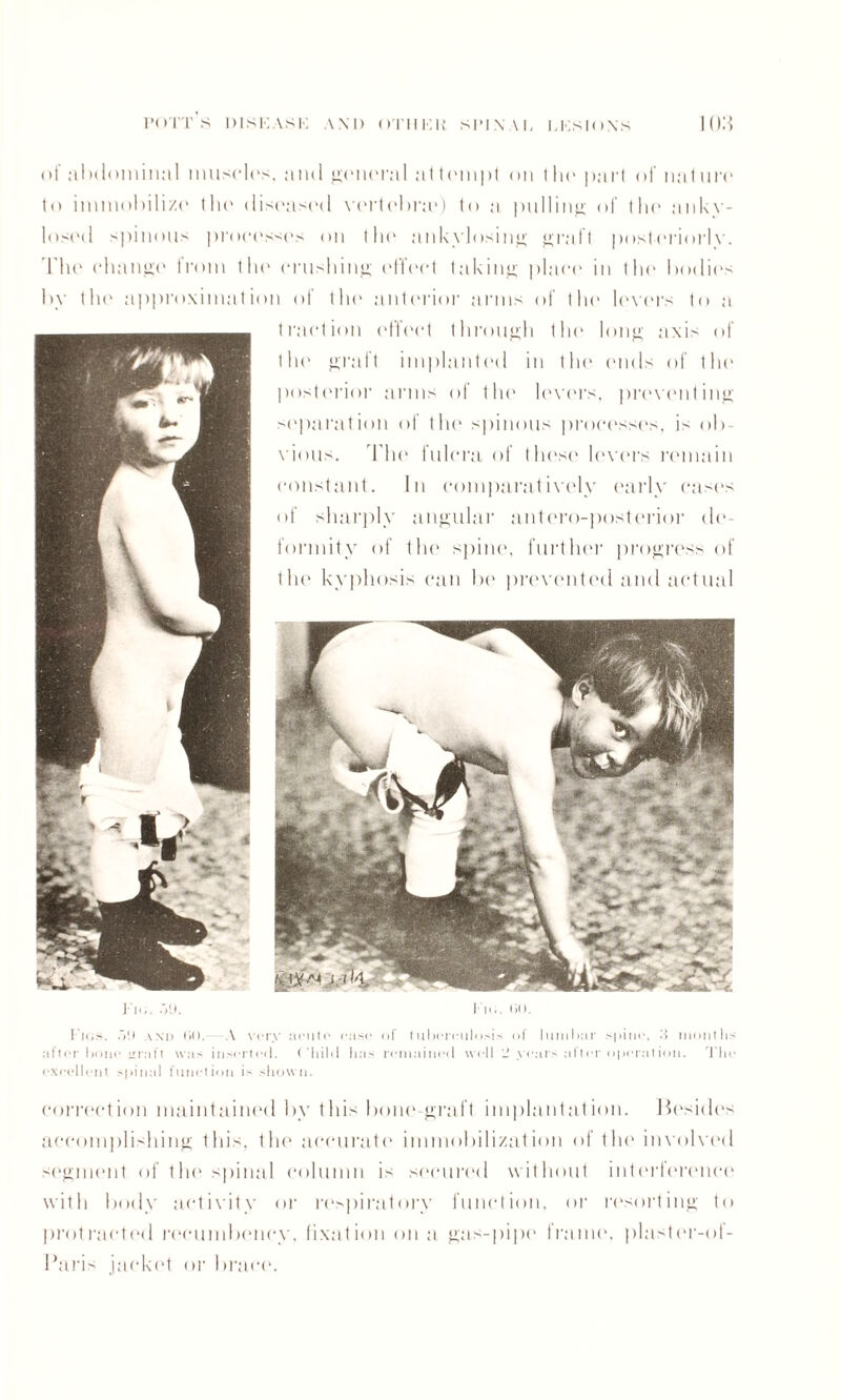 of abdominal 1 nil spies, and general a( tempt on I Ik* part of nailin' to immobilize tin1 diseased vertebrae) to a pulling of tin' ankv- losi'd spinous ])roeesses on tin' ankylosing graft posteriorly. The change from tin' crushing effect taking place in tin1 bodies by tin* approximation of tin' anterior arms of thi' level’s to a traction effect through the long axis of tin' graft implanted in the ends of the posterior arms of the levers, preventing separation of the spinous processes, is ob¬ vious. Die fulcra of these levers remain constant. In comparatively early cases of sharply angular antero-posterior de¬ formity of tin* spini', further progress of tin* kyphosis can be prevented and actual Tig. .>9. Tig. 00. Figs. 5!) and 00. A very acute case of tuberculosis of lumbar spine, d months after bone graft was inserted. ('Iiild lias remained well l! years after operation. The excellent spinal function is shown. correction maintained by this bone-graft implantation. Besides accomplishing this, the accurate immobilization of the involved segment of the spinal column is secured without interference with body activity or respiratory function, or resorting to protracted recumbency, fixation on a gas-pipe frame, plaster-of- I’aris jacket or brace.