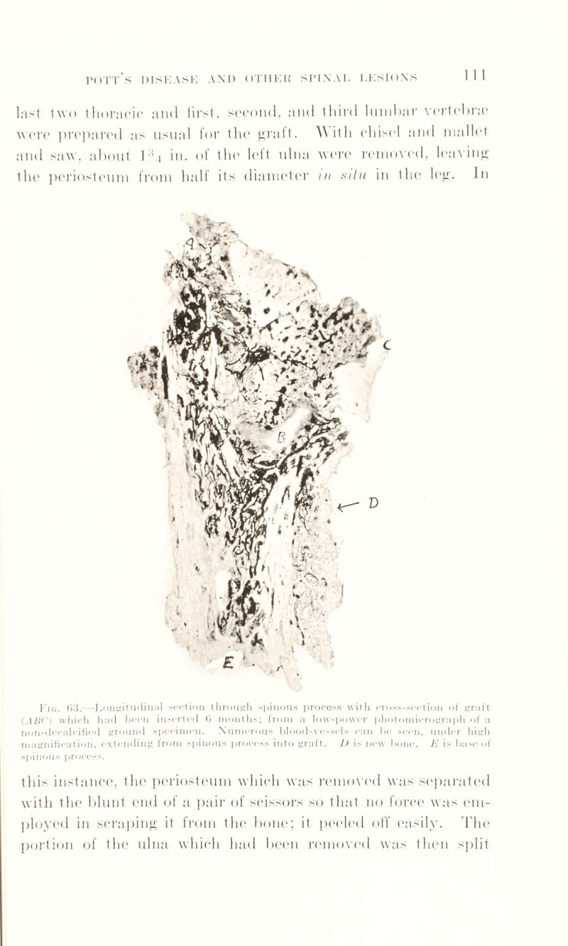 last two thoracic and first, second, and third lumbar vertebrae were prepared as usual for the grail. With chisel and mallet and saw. about 1i in. of the left ulna were removed, leaving the periosteum from half its diameter in silu in the leg. Jn Fig. 03. -Longitudinal section through spinous process with cross-section of graft (ABC) which had been inserted 0 months; from a low-power photomicrograph of a non-doealeified ground specimen. Numerous blood-vessels can be seen, under high magnification, extending from spinous process into graft. 1) is new hone. A’ is base of spinous process. this instance, the periosteum which was removed was separated with the blunt end of a pair of scissors so that no force was em¬ ployed in scraping it from the bone; it peeled off easily. The portion of the ulna which had been removed was then split