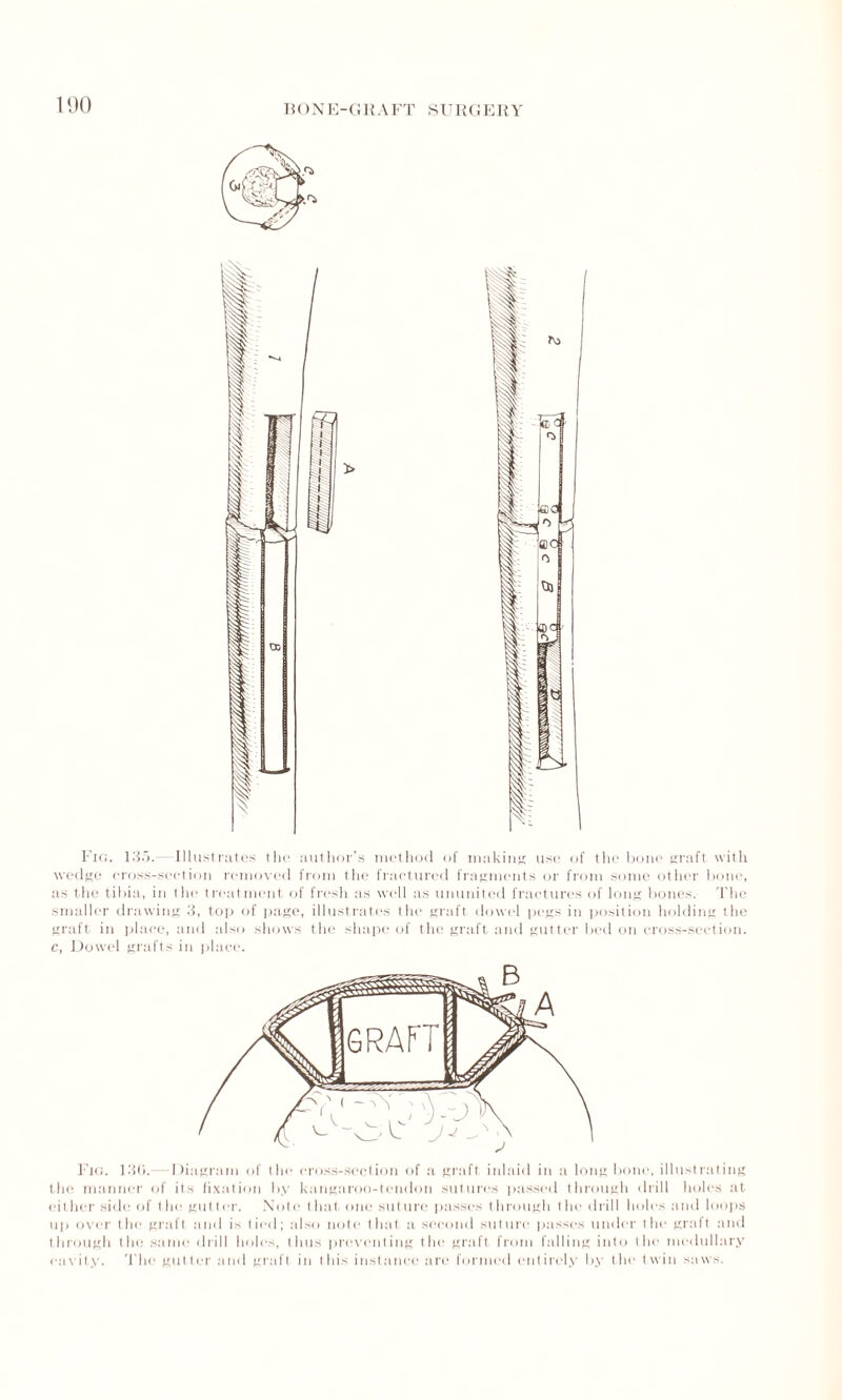 Fig. 135.- Illustrates the author’s method of making use of the bone graft with wedge cross-section removed from the fractured fragments or from some other bone, as the tibia, in the treatment of fresh as well as ununited fractures of long bones. The smaller drawing 3, top of page, illustrates the graft dowel pegs in position holding the graft in place, and also shows the shape of the graft and gutter bed on cross-section. c, Dowel grafts in place. Fig. 136.- Diagram of the cross-section of a graft inlaid in a long bone, illustrating the manner of its fixation by kangaroo-tendon sutures passed through drill holes at either side of the gutter. Note that one suture passes through the drill holes and loops up over the graft and is tied; also note that a second suture passes under the graft and through the same drill holes, thus preventing the graft from falling into the medullary cavity. The gutter and graft in this instance are formed entirely by the twin saws.