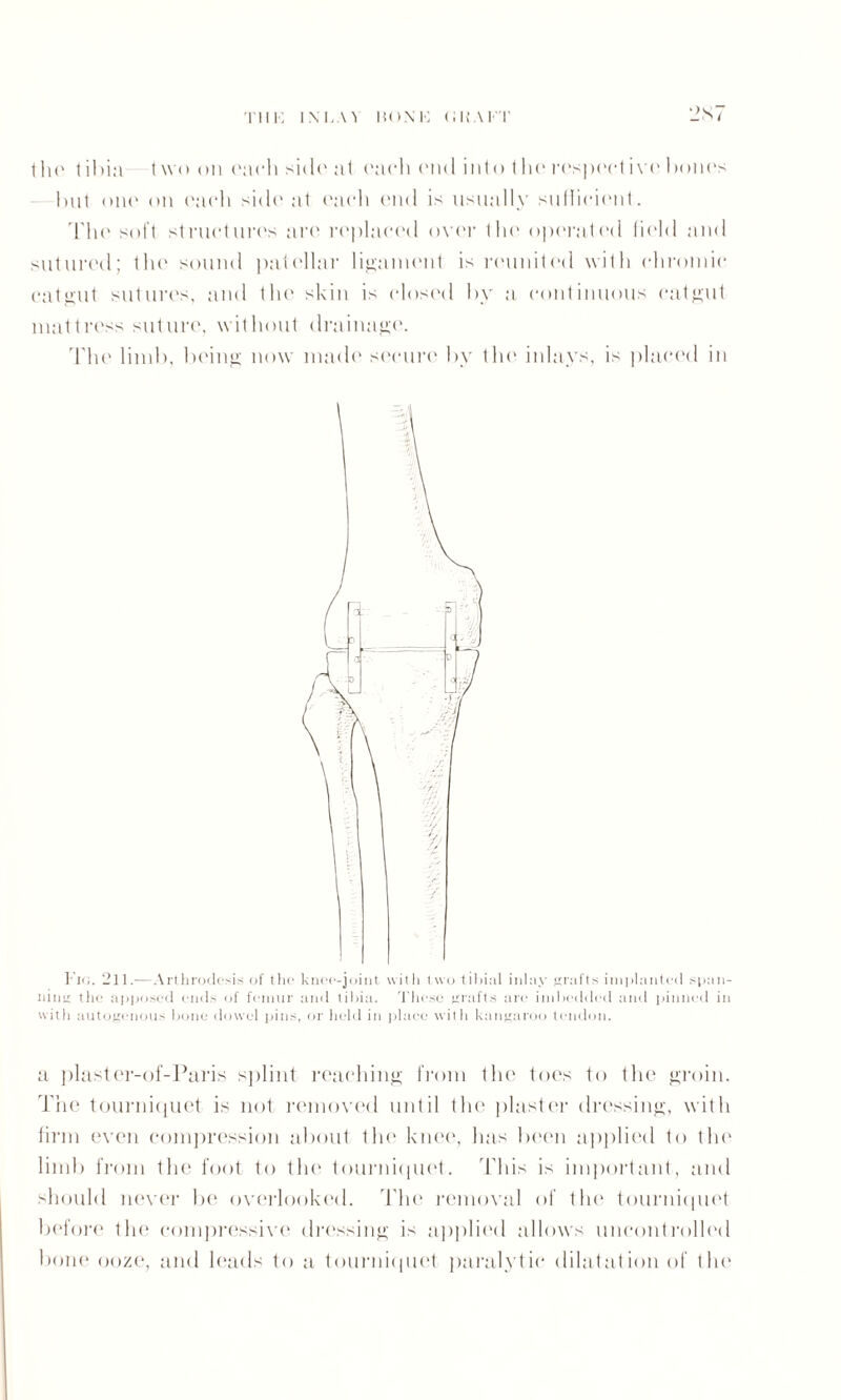 THE lNEA'l BONE (1 H A FT 2S7 I ho t il)ia (wo on each side at each end into the respect ivc hones hut one on each side at each end is usually sufficient. The soft structures are replaced over the operated field and sutured; the sound patellar ligament is reunited with chromic catgut sutures, and the skin is closed hv a continuous catgut mattress suture, without drainage. The limb, being now made secure by the inlays, is placed in Fin. 211.—Arthrodesis of the knee-joint with two tibial inlay grafts implanted span¬ ning the apposed ends of femur and tibia. Those grafts are imbedded and pinned in with autogenous bone dowel pins, or held in place with kangaroo tendon. a plastcr-of-Paris splint reaching from the toes to the groin. The tourniquet is not removed until the plaster dressing, with firm even compression about the knee, has been applied to the limb from the foot to the tourniquet. 'This is important, and should never be overlooked. The removal of iho tourniquet before the compressive dressing is applied allows uncontrolled bone ooze, and leads to a tourniquet paralytic dilatation of the