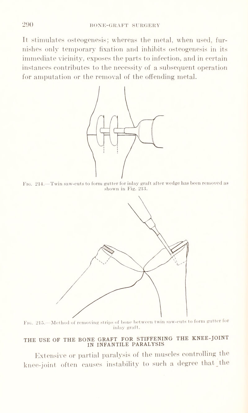 200 It stimulates osteogenesis; whereas the metal, when used, fur¬ nishes only temporary fixation and inhibits osteogenesis in its immediate vicinity, exposes the parts to infection, and in certain instances contributes to the necessity of a subsequent operation for amputation or the removal of the offending metal. Fig. 214—Twin saw-cuts to form gutter for inlay graft after wedge has been removed as shown in Fig. 213. Fig. 215.— Method of removing si rips of bone between twin saw-cuts to form gutter for inlay graft. THE USE OF THE BONE GRAFT FOR STIFFENING THE KNEE-JOINT IN INFANTILE PARALYSIS Extensive or partial paralysis ol the muscles controlling the knee-joint often causes instability to such a degree that^thc