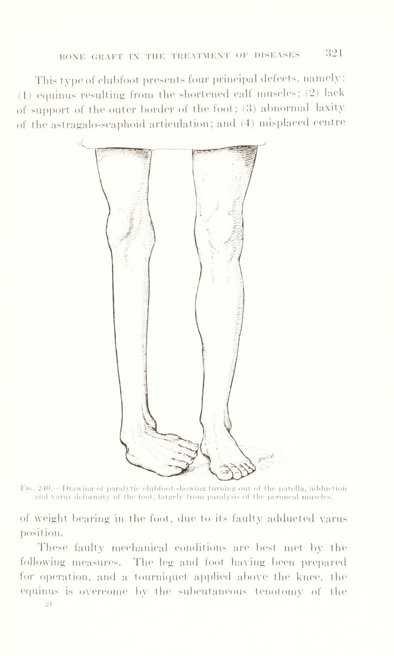 'This typo of clubfoot ])rosents four principal defect s, namely : (1) (’(piinus resulting from the shortened call muscles; (2) lack of support of the outer border of the loot; M) abnormal laxity of the astragalo-scaphoid articulation; and (4) mis])la(‘(‘d centre I Hi. 2-10.- Drawing of para! y I if clubfoot showing t liming out of the patella, adduction and varus deformity of the foot, largely from j)aralysis of the peroneal muscles. of weight bearing in the foot, due to its faulty adducted varus position. These faulty mechanical conditions are best met by the following measures. The leg and foot having been prepared for operation, and a tourniquet applied above the knee, the equinus is overcome by the* subcutaneous tenotomy of the 2l