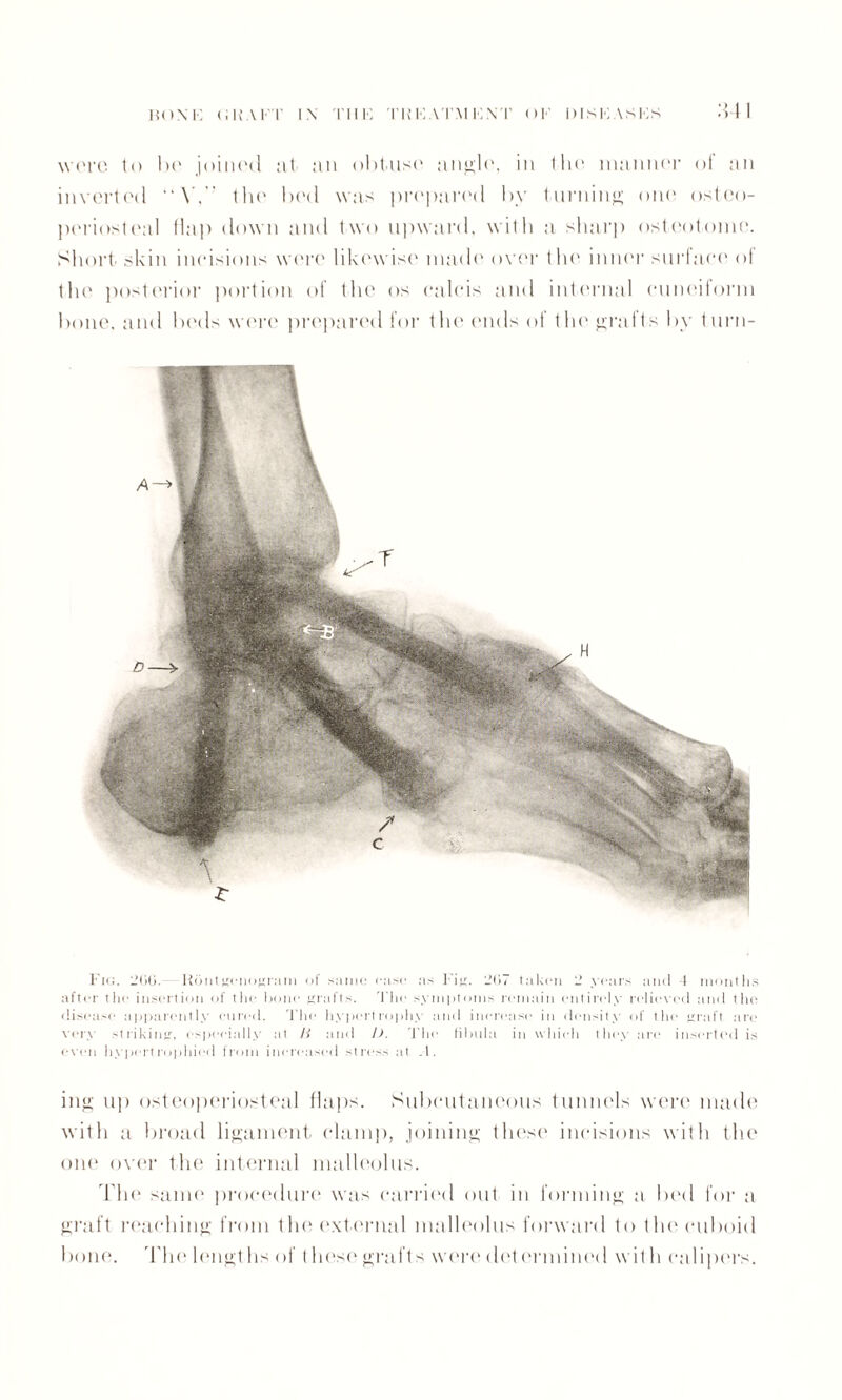 HoM': <;uaft i\ 1111: tkkat.m i:\t ok diskasks .S41 were to he joined at an obtuse angle, in the manner of an inverted “Y, the bed was prepared by turning one osteo¬ periosteal flap down and two upward, with a sharp osteotome. Short skin incisions were likewise made over t he inner surface ol the posterior portion of the os calcis and internal cuneiform bone, and beds were prepared for the (aids of the grafts by turn- Fig. 2(i(j. Roiitgonofjrani of same case as Fiji. 2(17 taken 2 years and 4 months after the insertion of the hone srafts. The symptoms remain entirely relieved and the disease apparently cured. The hypertrophy and increase in density of the Kraft are very strikiuK, especially at li and D. The fibula in which they are inserted is even hypertrophied from increased stress at .1. ing up osteoperiosteal flaps. Subcutaneous tunnels were made with a broad ligament damp, joining these incisions with the one over the internal malleolus. The same procedure was carried out in forming a bed for a graft reaching from the external malleolus forward to flit' cuboid bone. The lengths of these grafts wore determined with calipers.