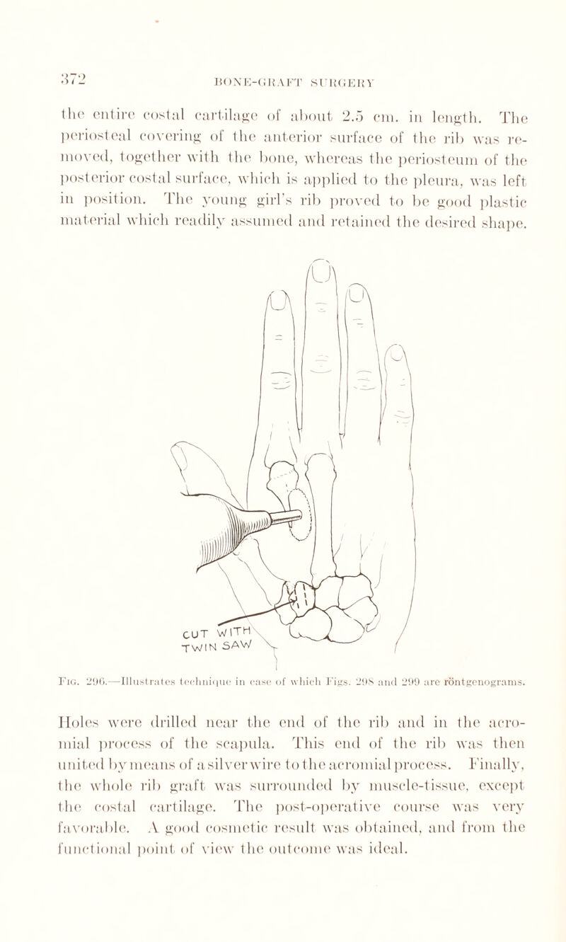 the entire costal cartilage of about 2.5 cm. in length. The periosteal covering of the anterior surface of the rib was re¬ moved, together with the bone, whereas the periosteum of the posterior costal surface, which is applied to the pleura, was left in position. The young girl’s rib proved to be good plastic material which readily assumed and retained the desired shape. Fig. 296.—Illustrates technique in ease of which Figs. 29s and 299 are rontgenograms. Holes were drilled near the end of the rib and in the acro¬ mial process of the scapula. This end of the rib was then united bymeans of asilverwire to the acromial process. Finally, the whole rib graft was surrounded by muscle-tissue, except the costal cartilage. The post-operative course was very favorable. A good cosmetic result was obtained, and from the functional point of view the outcome was ideal.