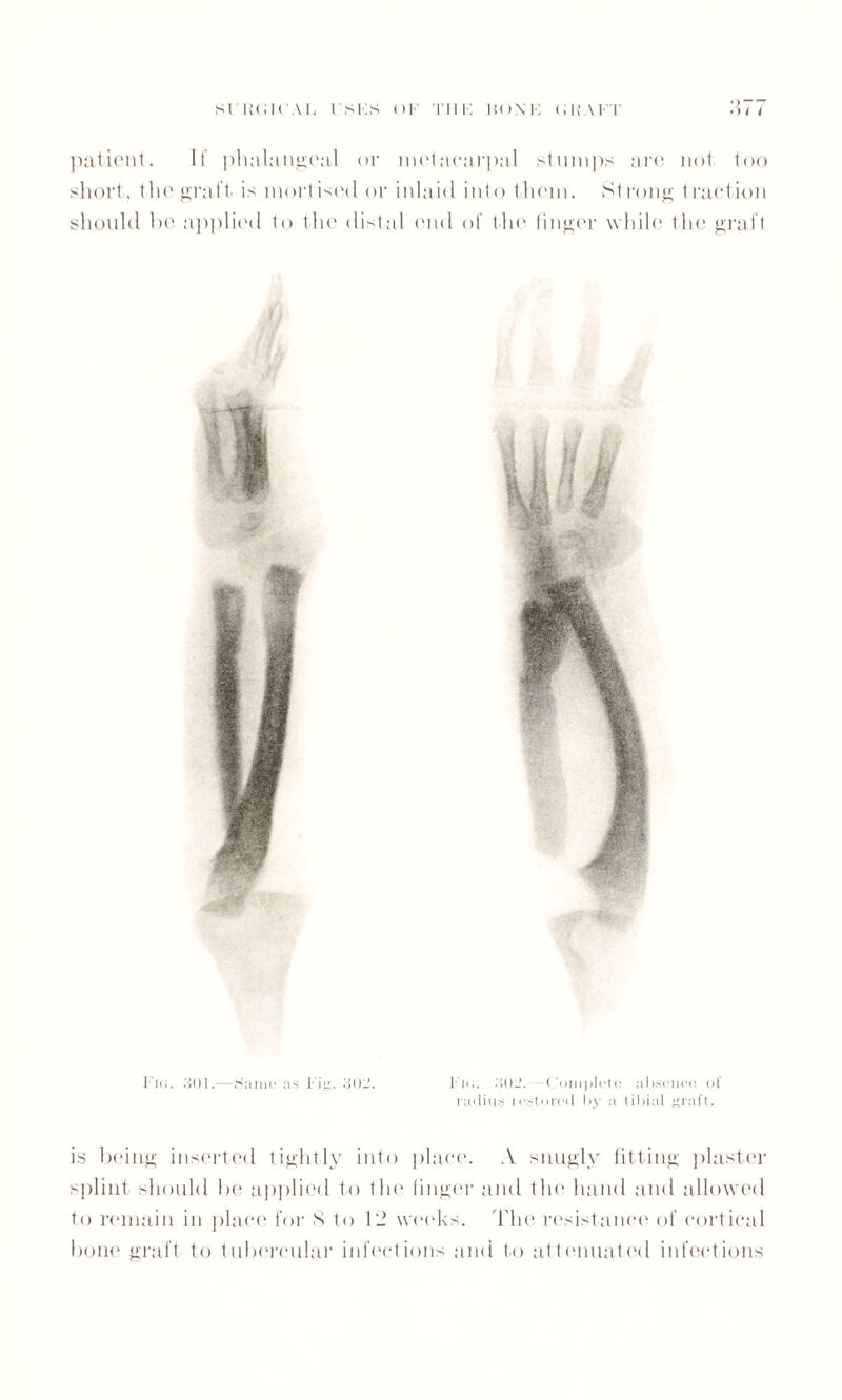 .) — ■-» patient. If phalangeal or metacarpal stumps are not too short. the graft is mort ised or inlaid into them. Strong t faction should he applied to the distal end of the finger while the graft 1'IG. 301.—Same as li«z. 302. I k;. 302. -Complete absence of radius restored by a tibia! graft. is being inserted tightly into place. A snugly fitting plaster splint should be applied to the linger and the hand and allowed to remain in place for S to 12 weeks. The resistance of cortical hone graft to tubercular infections and to attenuated infections