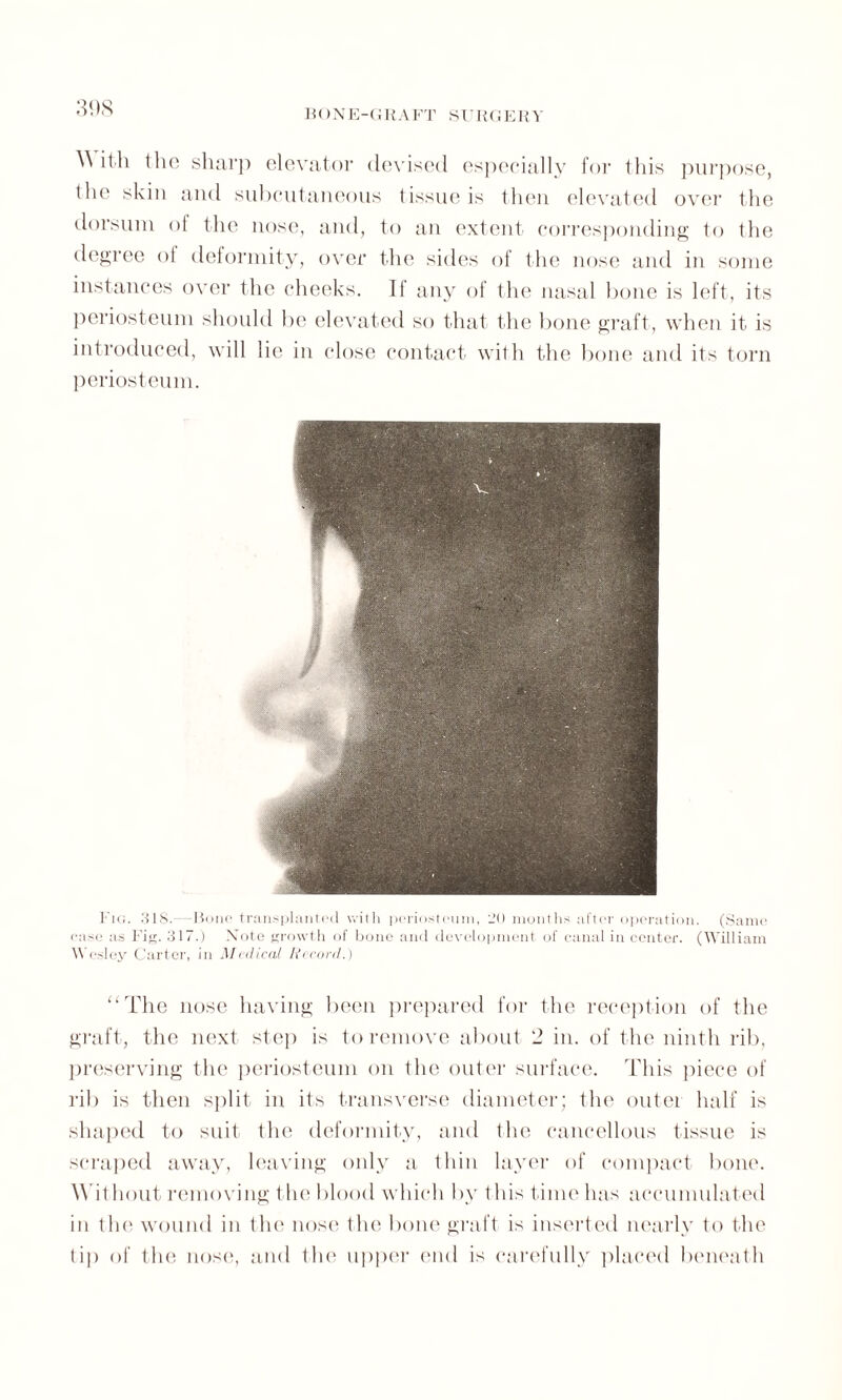 ^ ith the sharp elevator devised especially for this purpose, the skin and subcutaneous tissue is then elevated over the dorsum of the nose, and, to an extent corresponding to the degree ot deformity, over the sides of the nose and in some instances over the cheeks. It any of the nasal bone is left, its periosteum should be elevated so that the bone graft, when it is introduced, will lie in close contact with the bone and its torn periosteum. Fig. 318.—Rone transplanted with periosteum, 20 months after operation. (Same case as Fig. 317.) Note growth of bone and development of canal in center. (William Wesley Carter, in Medical Record.) “The nose having been prepared for the reception of the graft, the next step is to remove about 2 in. of the ninth rib, preserving the periosteum on the outer surface. This piece of rib is then split in its transverse diameter; the outei half is shaped to suit the deformity, and the cancellous tissue is scraped away, leaving only a thin layer of compact bone. Without removing t he blood which by t his time has accumulated in the wound in t lie nose the bone graft is inserted nearly to the tip of the nose, and the upper end is carefully placed beneath