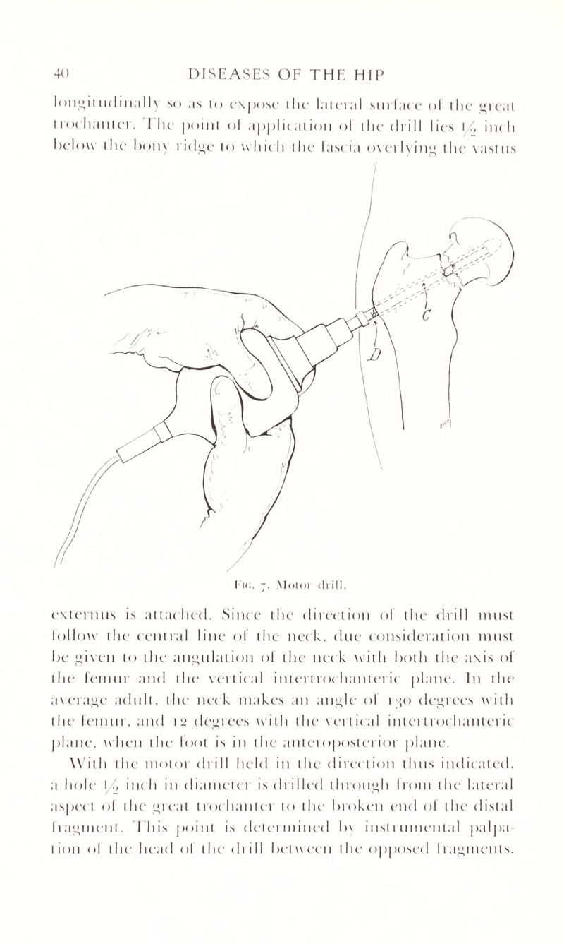 longitudinally so as lo expose the lateral surface ol the great trochanter. I he point ol application ol the- chill lies \/, inch below the bony ridge to whic h the1 lascia overlying the vastus externus is attached. Since the direction ol the chill must lollow the central line ol the neck, due consideration must he given to the angulation ol the neck with both the axis of the femur and the vertical intertrochanteric plane. In the average adult, the neck makes an angle of 1 go degrees with the femur, and 12 degrees with the vertical intertrochanteric plane, when the loot is in the anteroposterior plane. With the motor ch ill held in the direction thus indicated, a hole \/> me li in diameter is cli illed through liotn the lateral aspec t ol the great trochanter to the broken end ol the distal fragment. Ibis point is determined bv instrumental pa I pa lion ol the- head ol the chill between the- opposed liagments.