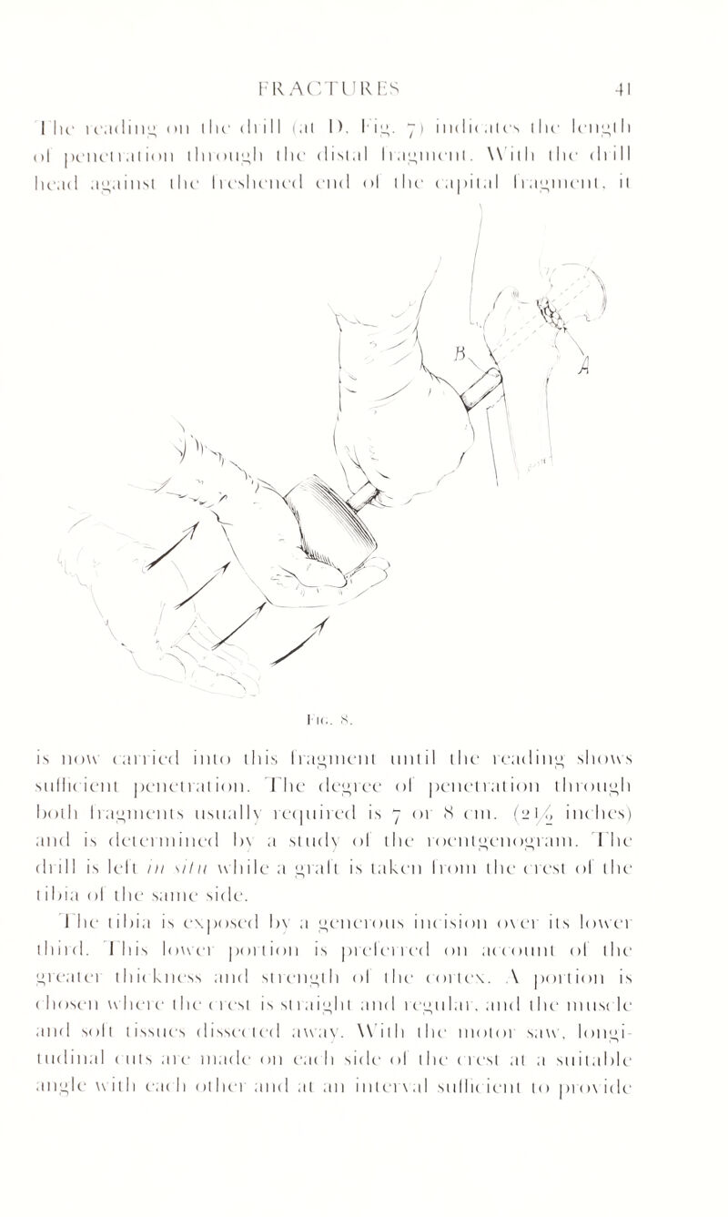 I lie reading on die diill (at I). lug. “) indicates the length ol penel i at ion through the distal I raiment. With the diill head against the- Ireshcned end ol the capital Iragmcnt, it is now carried into this fragment until the reading shows sufficient penetration. Ihe degree ol penetration through both fragments usually required is - or S cm. (21/, inches) and is determined by a study ol the roentgenogram. T he drill is left in silu while a graft is taken Irom the crest ol the t ihia ol the same side. 1 he tibia is exposed In a generous incision over its lowei third. I lus lower portion is prelerred on account ol the grealet thickness and strength ol the cortex. \ portion is ( lioscai where the c rest is straight and regular, and the muse le and soil tissues dissected away. Willi the motor saw, longi¬ tudinal cuts are made on each side ol the' (rest at a suitable angle with each of hei and at an in ten a I sullic ient to provide