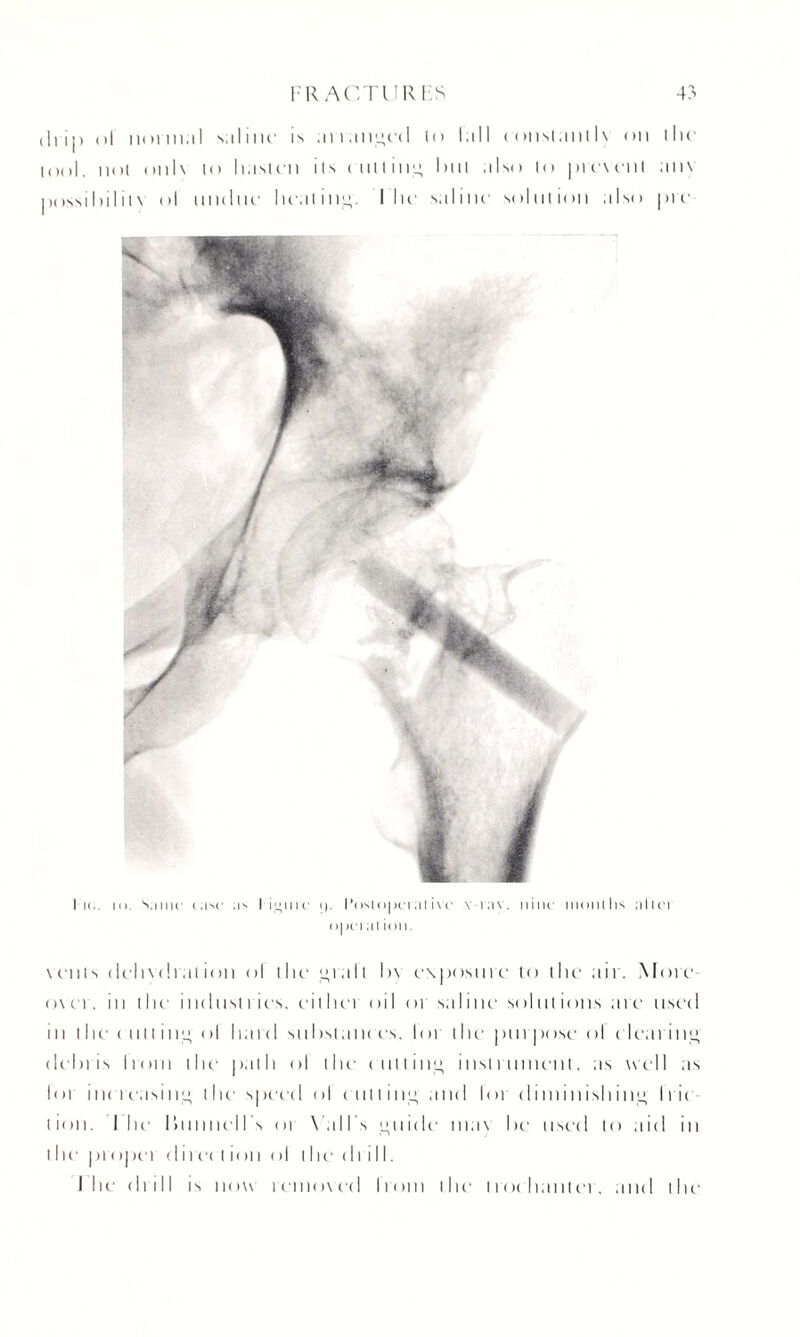drip ol normal saline' is ;maii;^'(l in lull <onsl.ml 1\ on the tool, not onl\ lo liaslcn Us culling lull also to prewemt am possibililN ol undue' healing. Mu' saline solution also pie I k., m. S.iinc eisc as !■ ij>ure (). I’osiopei at ive v-rav. nine inonllis alio opei ai ion. \enis deli\(!i at ion ol the grab h\ exposure to the air. More' o\cr, in the industries, eithei oil or saline solutions are used in the ( lit t i 11 o ol hard si i list at ices, lor the purrx >se ol el earing debris Ironi the' path ol die' earning instrument, as well as loi iik 1 easing the' speed ol < lining and lor diminishing Irie lion. I lie' Irunne'll s or \ all s guide mas he used to aid in the pie (per d i ree l ion ol the drill. I lie' drill is now removed Ironi the' trochanter, and the1