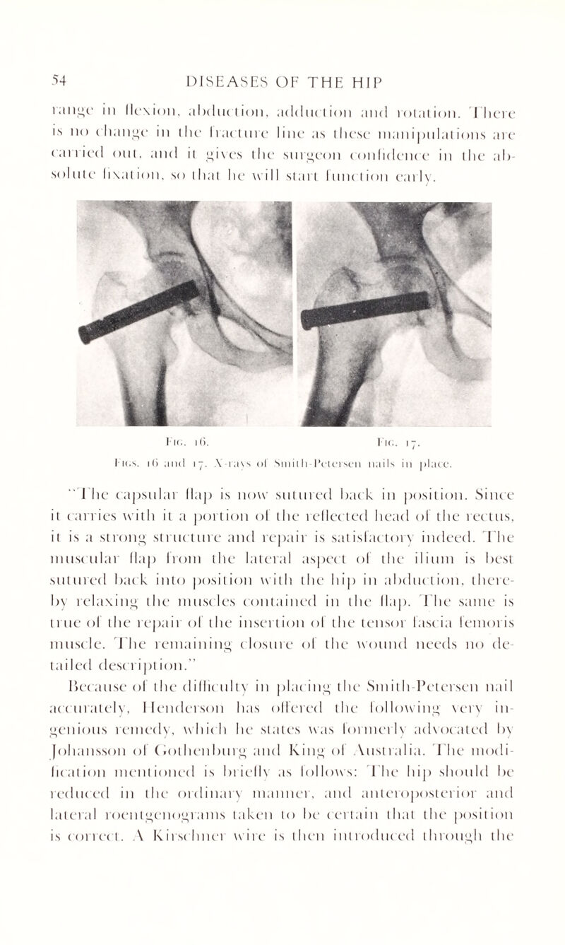 innge in llexion, abduction, adduction and rotation. I here ls ll<) change in the Iracture line as these mani]iiilal ions are carried out, and it gives the surgeon confidence in the ah solute fixation, so that he will start lunction early. l ie.. i(i. tic. 17. 1' Kis. ill and 17. \-ra\s of Smiili-Pciciscn nails in place. I lie capsulai Map is now sutured hack in position. Since it carries with it a portion ol the reflected head ol the rectus, it is a strong struc ture and repair is satisfactory indeed. The muscular Map Irom the lateral aspect ol the ilium is hest sutured hack into position with the hip in abduction, there¬ by relaxing- the muscles contained in the Nap. The same is true ol the repair of the insertion ol the tensor fascia lemoris muscle. The remaining closure ol the wound needs no de¬ tailed descript ion. Because ol the dillic ulty in plac ing the Smith Petersen nail accurately, Henderson has offered the following ver\ in genious remedy, which he states was lormerh advocated by Johansson of (iothenburg and King ol Australia. The modi hcation mentioned is hrielh as lollows: 1 he hip should he reduced in the ordinarx manner, and anteroposterior and lateral roentgenograms taken to he certain that the position is correct. A Kirschner wire is then introduced through the