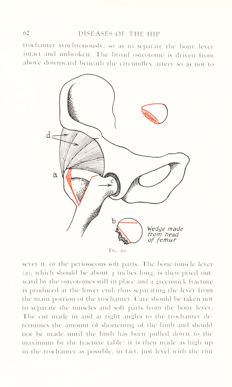 l rod inn ter synchrououslx. so as to separate the bonx lexer i lit act .uni unbroken. I lie broad osteotome in driven Irotn aboxe downward beneath the circumflex arterx so as not to sexer it. oi the periosseous soli parts. I 1 ie bone muse le level (a), w'liieh should be about | inches long. is then pried out ward bx the osteotomes st ill in plat e and a greens tit k I rat t lire is produced at the lower end. thus separating the lexer Ironi the main portion ol the trochanter. Care should be taken not to separate the muscles and soil parts Irotn the bonx lexer. The cut made in and at right angles to the trot hauler tie termines the amount ol shortening ol the limb and should not be made until the limb has been pulled down to the maximum bx the Iracture table: it is then made as high up in the trochanter as possible, in laet. just lexel with the rim