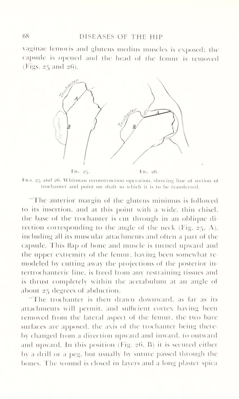 vaginae lemon's and gluteus medius muscles is exposed; the c apsule is opened and 111 c* head ol the lemur is removed (Figs, ipr, and idi). I ion. yr, and jti. W'hiimaii i econst rut t ion opeiation, showing line ol section ol not h.inter anti point on shall to which it is to he transl'ei letl. I lie anterior margin ol the gluteus minimus is followed to its insertion, and at this point with a wide, thin chisel, the base ol the trochanter is cut through in an oblique di¬ lection corresponding to the' angle ol the nec k (T ig. 25, A), inc hiding all its muscular attac lunents and often a part of the capsule. This llap ol bone and musc le is tinned upward and the upper extremity of the lemur, having been somewhat re modeled by c utting away the projections ol the posterior in¬ tertrochanteric line, is freed from any restraining tissues and is thrust completely within the acetabulum at an angle ol about 2y degrees ol abduc tion. “The trochanter is then drawn downward, as far as its attac hments will permit, and sulltc ient cortex having been removed Irom the lateral aspect ol the lemur, the two bare surfaces are apposed, the axis ol the trochanlei being there¬ by changed from a direct ion upw ard and inw ard, to outward and upward. In this position (Tig. idi, 1>) it is sec tired eitliet by a chill 01 a peg. but usually b\ suture passed through the bones. I he wound is c losed in layers and a long plaster spica