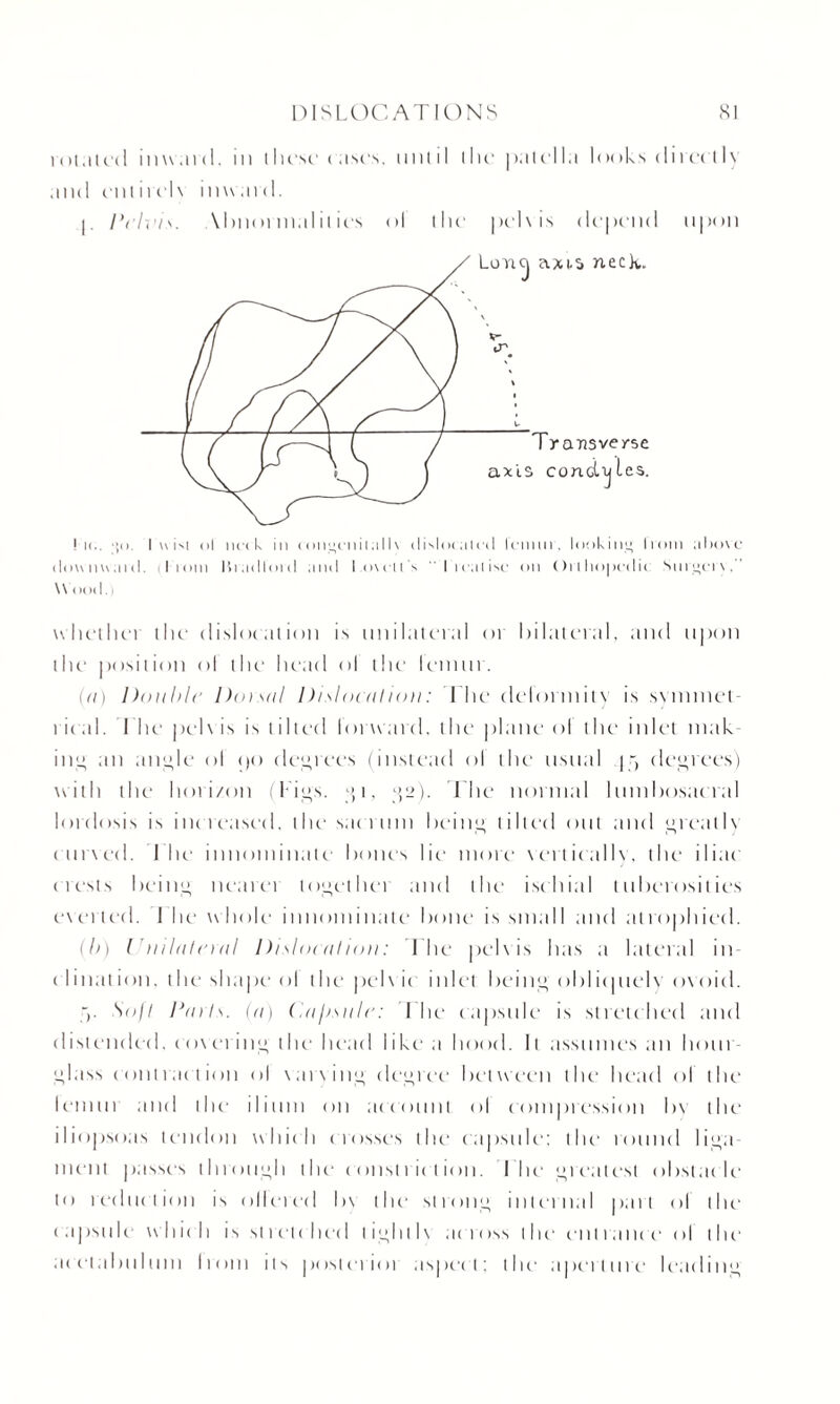 totaled inward, in I hese c ases. until the pat el la looks directIv and ent it civ inward. p I’clvi \bnormal it ics ol the pelvis depend upon Ik.. ■*< >. I wini ol iH'tk in < oiigenit al I \ disloi alol lemur, looking Iroin above downwind. Iiom Bradford and Lovett's treatise on Oilho|)edic Niii'j’cia \\ nod.! whether the dislocation is unilateral or bilateral, and upon the position ol the head ol the lemur. up Double Dot.sal Distocution: The delormitv is svmmet- t ieal. Lite pel\ is is tilted lorward, the plane ol the inlet mak¬ ing an angle ol cjo decrees (instead ol the usual jr, degrees) with the hot i/on (Figs. ;i, 32). The normal lumbosac ral lordosis is increased. 1 he sacrum being tilted out and greatlv curved. Fite innominate bones lie more vertically, the iliac crests being nearei together and the ischial tuberosities evened. I he whole innominate bone is small and atrophied. (b) l ’nilateral Dislocation: I he pelvis has a lateral in- el i nation, t he shape ol the pelv ic inlet being ol diet uely ovoid. Soft Dints, (a) (.a/i.siilr: i lie- capsule is stretc hed and distended, covering the head like a hood. It assumes an hour¬ glass contraction ol varving degree between the head ol the lemur and the- ilium on account ol compression bv the iliopsoas tendon which crosses the capsule; the round liga¬ ment passes through the constriction. Flic greatest obstacle to reduction is ollcred bv the strong internal part ol the capsule which is stretched lighllv across the entrance ol the acetabulum Iron) its posterioi aspec t; the aperture leading