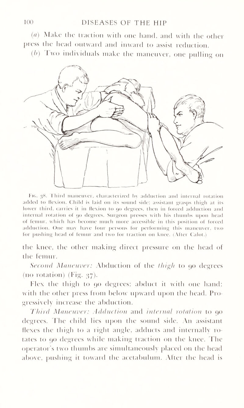 (a) Make the traction with one hand, and with the othet press the head outward and inward to assist reduction. (b) I wo individuals make the maneuver, one pulling on added to flexion. Child is laid on its sound side; assistant grasps thigh at its lower third, carries it in llexion to go degrees, then in forced adduction and internal rotation ol go degrees. Surgeon presses with his thumbs upon head ol femur, which has become much more accessible in this position of lotted adduction. One mac have four persons for performing this maneuver, two for pushing head ol femur and two for traction on knee. (Allen Calol.) the knee, the othei making direct pressure on the head ol the lemur. Second Maneuver: Abduction ol the I high to cjo degrees (no rotation) (Tig. ^7). Hex the thigh to cjo degrees; abduct ii with one hand; w ith the other press Irom below upward upon the head. Pro gressively increase the abduction. Third Maneuver: .Adduct ion and internal rotation to cjo degrees. I he child lies upon the sound side. An assistant Ilexes the thigh to a right angle, adducts and internallv ro¬ tates to cjo degrees while making traction on the knee. Hie operator’s two thumbs are simul laneouslv placed on the head above, pushing it toward the acetabulum. Alter the head is