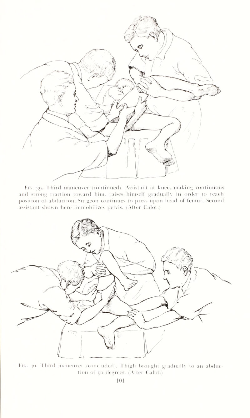 In,. >’(). I bird manemei uonlintiedi. \ssistanl ai knee, making continuous and strong tiartion Umanl him. raises himscll gradually in order lo reach position ol ahdniiion. Surgeon continues to press upon head ol lemur. Second assistant shown here immobilizes pel\ is. i M’tei (allot.) Ik.. |o. I bird maneuver until lulled). I high brought gradually loan ahdtn lion ol (jo degrees. (Alter (allot.)