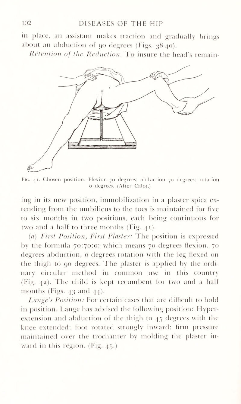 in place, an assistant makes traction and gradually Ininas about an abduction ol 90 degrees (Figs. ^8-90). Relent ion of the Red net ion. To insure the head’s remain I k.. 11. Chosen position. Flexion 70 degrees; abduction 70 degrees; rotation o degrees. (After Calot.) ing in its new position, immobilization in a plaster spiea ex¬ tending from the umbilicus to the toes is maintained for five to six months in two positions, each being continuous for two and a half to three months (Fig. j 1). (a) First Position, First Plaster: The position is expressed by the formula 70:70:0; which means 70 degrees flexion, 70 degrees abduction, o degrees rotation with the leg Hexed on the thigh to 90 degrees. The plaster is applied by the ordi¬ nary circular method in common use in this country (Fig. (2). The child is kept recumbent for two and a hall months (Figs, j9 and | (). Lange’s Position: For certain cases that are dillic illt to hold In posit ion, Lange has advised the lollowing posit ion: Hyper- extension and abduction ol the thigh to ]7 degrees with the knee extended: loot totaled strongly inward; linn pressure maintained over the trochanter by molding the plaster in¬ ward in this region. (Fig. |f>.)