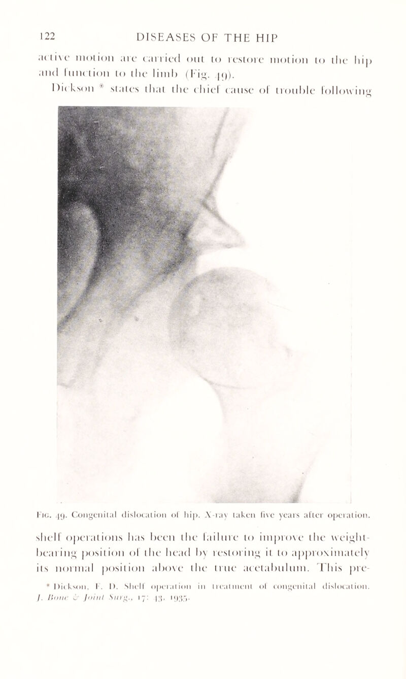 ;icii\c motion arc canted out to restore motion to the lti|> and I unction to the limb (Pig. pj). Die kson slates that the c Itiel cause ol trouble following Ik;. 49. Congenital dislocation ol hip. X-ray taken five years after operation. shelf operations has been the failure to improve the weight- bearing position ol the head by restoring it to appro\imatel\ its normal position above the true acetabulum. This pie * Dickson. I I). Shell' operation in treatment ol congenital dislocation. /. Hone X loint Sing., 17: |;j, 19;}.-,.