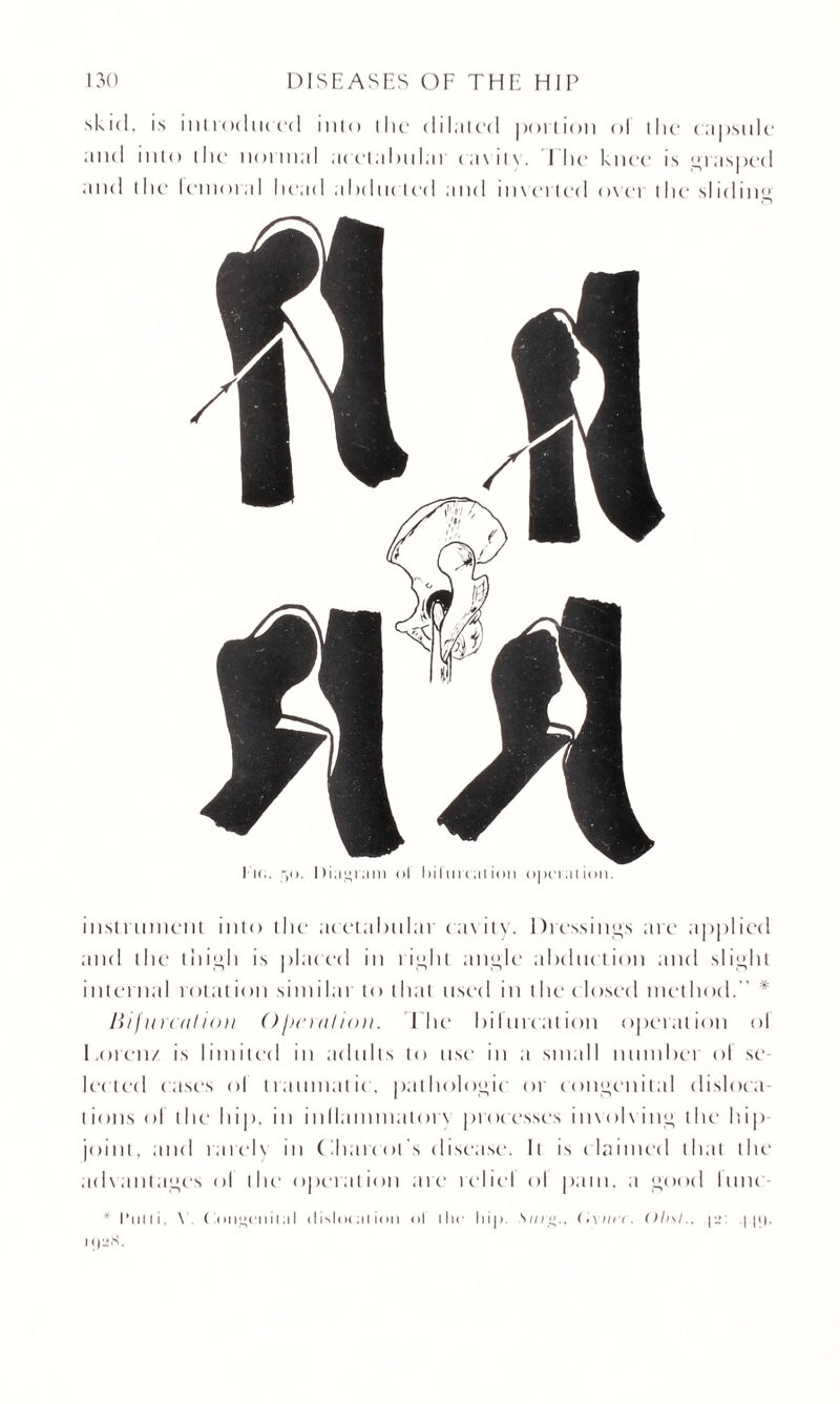 skid, is introduced into the dilated portion ol the capsule and into the normal acetabular cavity. The knee is grasped and the lent ora I head abducted and in vet ted over the si id i n^ instrument into the acetabular cavity. Dressings are applied and the thigh is placed in right angle abduction and slight internal rotation similar to that used in the closed method. * lii / in cal ion O deration. The bifurcation operation ol Loren/ is limited in adults to use in a small number ol se¬ lected cases ol traumatic, pathologic or congenital disloca¬ tions ol the hip, in inllammalorv processes involving the hip joint, and lately in Charcot's disease. It is claimed that the advantages ol the1 operation are rebel ol pam, a good lime ' I’utli. \ C .on»ciiil;il <iislo< ;ii ion ol the hip. S i/i., ('•xini. ()b\l., p_* | |(). i i|-S.